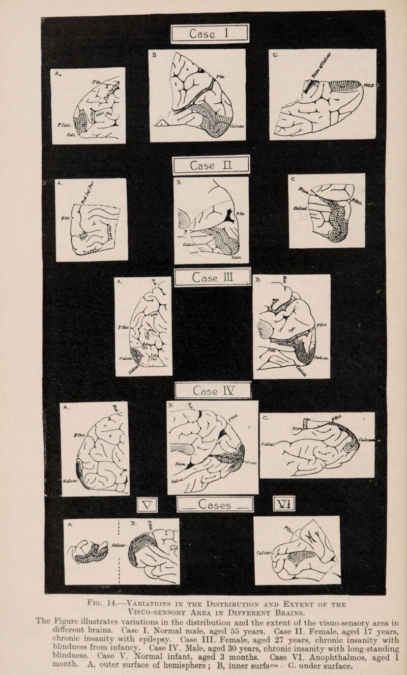 Fig. 14.—Variations in the Distribution and Extent of the VlSUO-SENSORY AREA IN DIFFERENT BRAINS. J he figure illustrates variations in the distribution and the extent of the visuo-sensory area in different brains. Ease I, Normal male, aged 55 years. Case II, Female, aged 17 years, chronic insanity with epilepsy. Case III, Female, aged 27 years, chronic insanity with blindness from infancy. Case IV, Male, aged 30 years, chronic insanity with long-standing blindness. Case V, Normal infant, aged 3 months. Case VI, Anophthalmos, aged 1 month. A, outer surface of hemisphere ; B, inner surfa°ft - C. under surface.