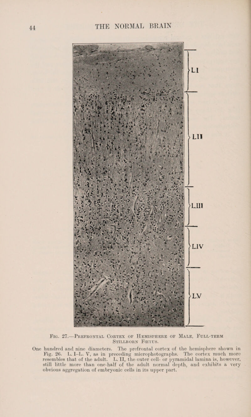 '; *Vv ’ V* l'f ; XV^ ‘ He ™ ... * .* LI I >LV Fig. 27.—Prefrontal Cortex of Hemisphere of Male, Full-term Stillborn Fcetes. One hundred and nine diameters. The prefrontal cortex of the hemisphere shown in Fig. 2b. L. I—L. V, as in preceding microphotographs. The cortex much more resembles that of the adult. L. II, the outer cell- or pyramidal lamina is, however, still little more than one-half of the adult normal depth, and exhibits a very obvious aggregation of embryonic cells in its upper part.