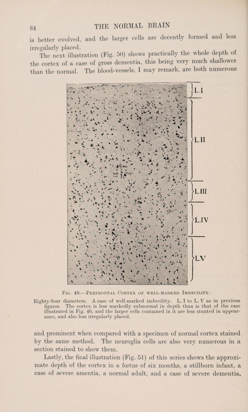 is better evolved, and the larger cells are decently formed and less irregularly placed. The next illustration (Fig. 50) shows practically the whole depth ot the cortex of a case of gross dementia, this being very much shallower than the normal. The blood-vessels, I may remark, are both numerous Fig. 49.—Prefrontal Cortex of well-marked Imbecility. Eighty-four diameters. A case of well-marked imbecility. L. I to L. V as in previous figures. The cortex is less markedly subnormal in depth than is that of the case illustrated in Fig. 46, and the larger cells contained in it are less stunted in appear¬ ance, and also less irregularly placed. and prominent when compared with a specimen of normal cortex stained by the same method. The neuroglia cells are also very numerous in a section stained to show them. Lastly, the final illustration (Fig. 51) of this series shows the approxi¬ mate depth of the cortex in a foetus of six months, a stillborn infant, a case of severe amentia, a normal adult, and a case of severe dementia.