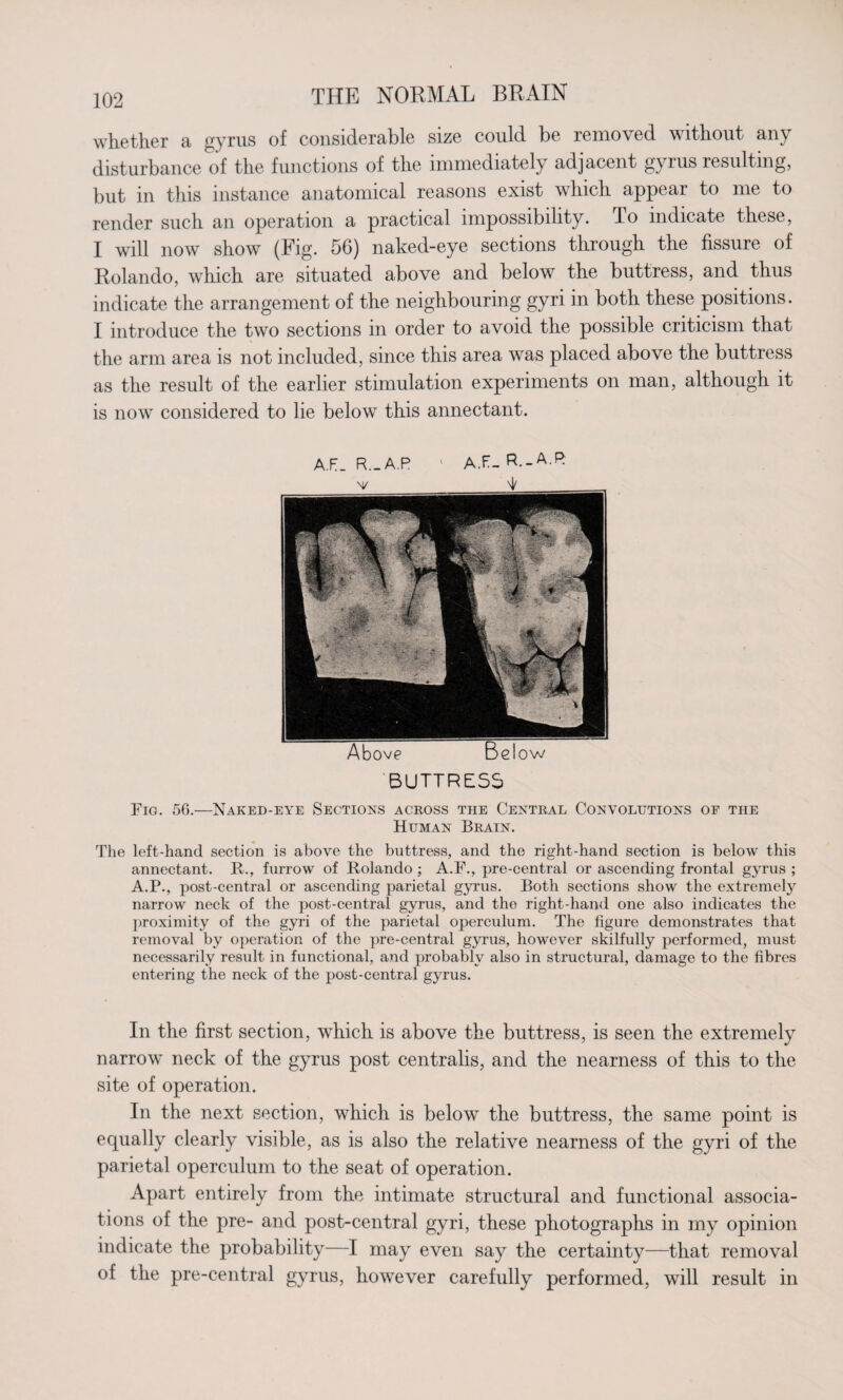 whether a gyrus of considerable size could be removed without any disturbance of the functions of the immediately adjacent gyrus resulting, but in this instance anatomical reasons exist which appear to me to render such an operation a practical impossibility, do indicate these, I will now show (Fig. 56) naked-eye sections through the fissure of Rolando, which are situated above and below the buttress, and thus indicate the arrangement of the neighbouring gyri in both these positions. I introduce the two sections in order to avoid the possible criticism that the arm area is not included, since this area was placed above the buttress as the result of the earlier stimulation experiments on man, although it is now considered to lie below this annectant. A.FT_ R._A.R 1 A.F- R.-A ^ Above b clow BUTTRESS Fig. 56.—Naked-eye Sections across the Central Convolutions oe the Human Brain. The left-hand section is above the buttress, and the right-hand section is below this annectant. R., furrow of Rolando ; A.F., pre-central or ascending frontal gyrus ; A.P., post-central or ascending parietal gyrus. Both sections show the extremely narrow neck of the post-central gyrus, and the right-hand one also indicates the proximity of the gyri of the parietal operculum. The figure demonstrates that removal by operation of the pre-central gyrus, however skilfully performed, must necessarily result in functional, and probably also in structural, damage to the fibres entering the neck of the post-central gyrus. In the first section, which is above the buttress, is seen the extremely narrow neck of the gyrus post centralis, and the nearness of this to the site of operation. In the next section, which is below the buttress, the same point is equally clearly visible, as is also the relative nearness of the gyri of the parietal operculum to the seat of operation. Apart entirely from the intimate structural and functional associa¬ tions of the pre- and post-central gyri, these photographs in my opinion indicate the probability—I may even say the certainty—that removal of the pre-central gyrus, however carefully performed, will result in