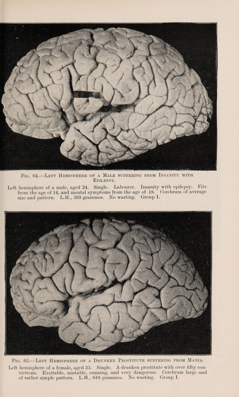 Fig. 64.—Left Hemisphere of a Male suffering from Insanity with Epilepsy. Left hemisphere of a male, aged 24. Single. Labourer. Insanity with epilepsy. Fits from the age of 14, and mental symptoms from the age of 18. Cerebrum of average size and pattern. L.H., 593 grammes. No wasting. Group I. Fig. 65.—Left Hemisphere of a Drunken Prostitute suffering from Mania. Left hemisphere of a female, aged 35. Single. A drunken prostitute with over fifty con¬ victions. Excitable, unstable, cunning, and very dangerous. Cerebrum large and