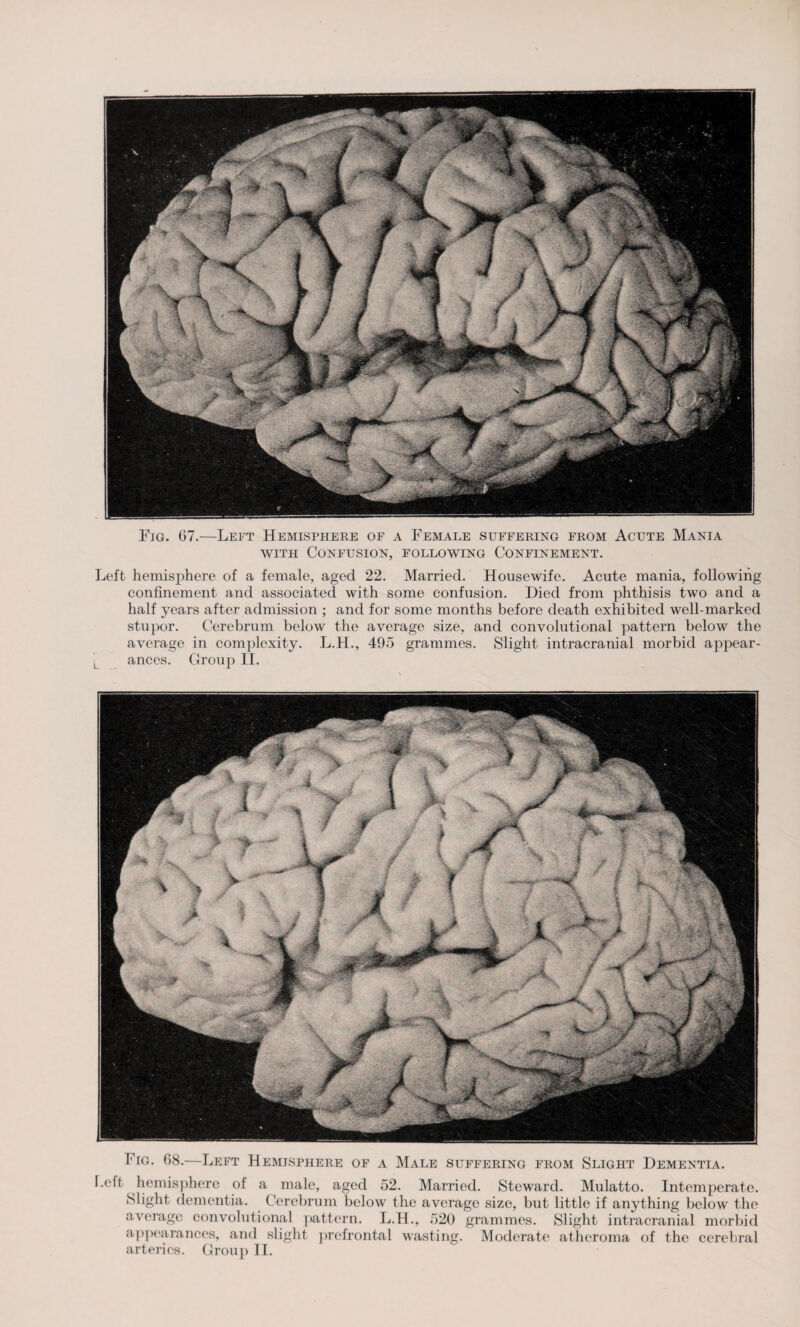 with Confusion, following Confinement. Left hemisphere of a female, aged 22. Married. Housewife. Acute mania, following confinement and associated with some confusion. Died from phthisis two and a half years after admission ; and for some months before death exhibited well-marked stupor. Cerebrum below the average size, and convolutional pattern below the average in complexity. L.H., 495 grammes. Slight intracranial morbid appear¬ ances. Group II. Fig. 68.—Left Hemisphere of a Male suffering from Slight Dementia. I.eft hemisphere of a male, aged 52. Married. Steward. Mulatto. Intemperate. Slight dementia. Cerebrum below the average size, but little if anything below the average convolutional pattern. L.H., 520 grammes. Slight intracranial morbid appearances, and slight prefrontal wasting. Moderate atheroma of the cerebral arteries. Group II.