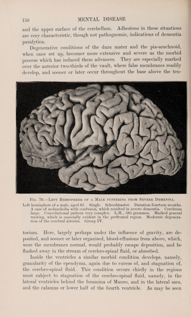 and the upper surface of the cerebellum. Adhesions in these situations are very characteristic, though not pathognomic, indications of dementia paralytica. Degenerative conditions of the dura mater and the pia-arachnoid, when once set up, becomes more extensive and severe as the morbid process which has induced them advances. They are especially marked over the anterior two-thirds of the vault, where false membranes readily develop, and sooner or later occur throughout the base above the ten- Fig. 70.—Left Hemisphere of a Male suffering from Severe Dementia. Left hemisphere of a male, aged 61. Single. Schoolmaster. Duration fourteen months. A case of melancholia with confusion, which resulted in severe dementia. Cerebrum large. Convolutional pattern very complex. L.H., 585 grammes. Marked general wasting, which is especially evident in the prefrontal region. Moderate degenera¬ tion of the cerebral arteries. Group IV. torium. Here, largely perhaps under the influence of gravity, are de¬ posited, and sooner or later organised, blood-effusions from above, which, were the membranes normal, would probably escape deposition, and be flushed away in the stream of cerebro-spinal fluid, or absorbed. Inside the ventricles a similar morbid condition develops, namely, granularity of the ependyma, again due to excess of, and stagnation of, the cerebro-spinal fluid. This condition occurs chiefly in the regions most subject to stagnation of the cerebro-spinal fluid, namely, in the lateral ventricles behind the foramina of Munro, and in the lateral sacs, and the calamus or lower half of the fourth ventricle. As mav be seen