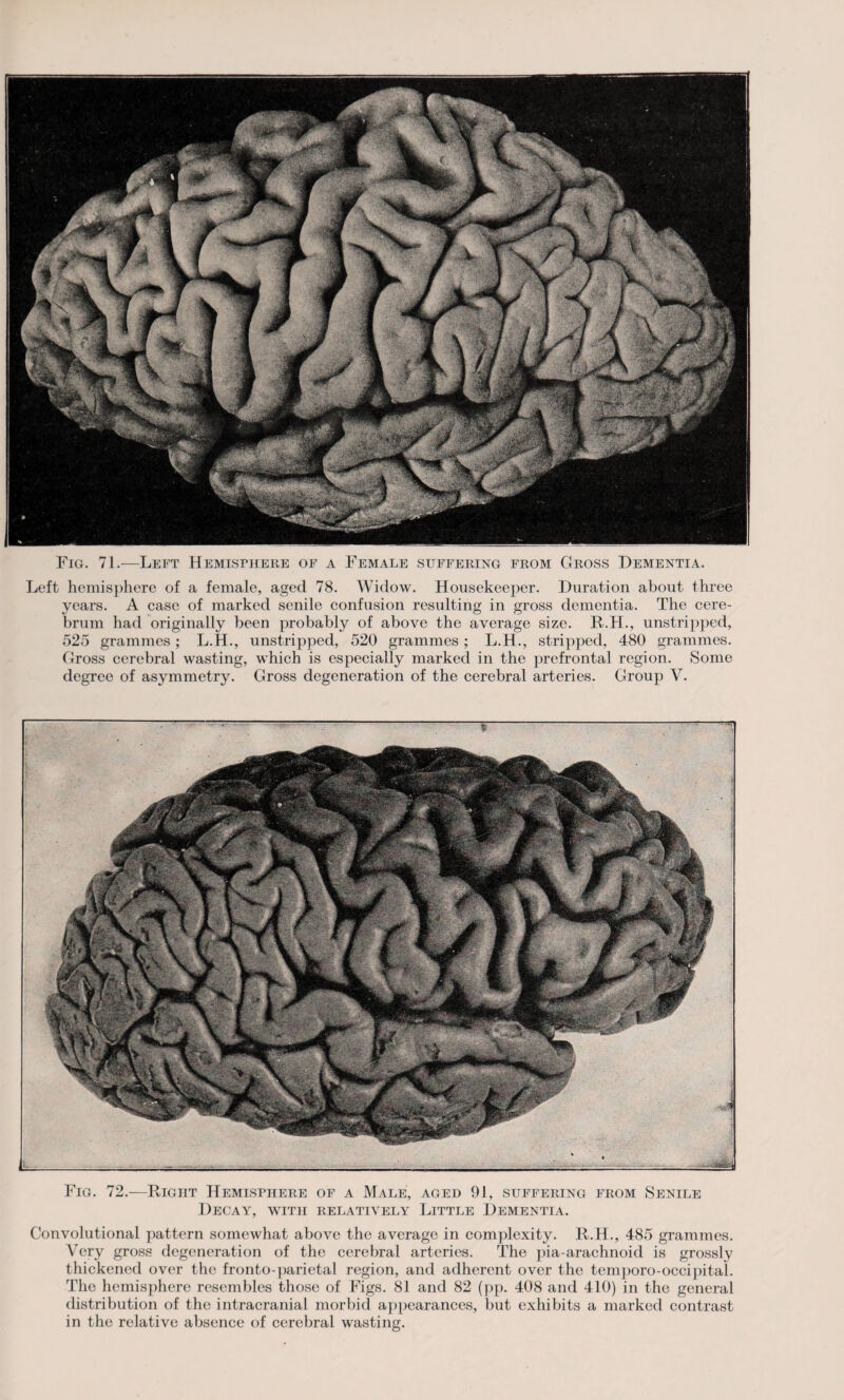 Left hemisphere of a female, aged 78. Widow. Housekeeper. Duration about three years. A case of marked senile confusion resulting in gross dementia. The cere¬ brum had originally been probably of above the average size. R.H., unstripped, 525 grammes; L.H., unstripped, 520 grammes; L.H., stripped, 480 grammes. Gross cerebral wasting, which is especially marked in the prefrontal region. Some degree of asymmetry. Gross degeneration of the cerebral arteries. Group V. * — '--7, Fig. 72.—Right Hemisphere of a Male, aged 91, suffering from Senile Decay, with relatively Little Dementia. Convolutional pattern somewhat above the average in complexity. R.H., 485 grammes. Very gross degeneration of the cerebral arteries. The pia-arachnoid is grossly thickened over the fronto-parietal region, and adherent over the temjioro-occipitah The hemisphere resembles those of Figs. 81 and 82 (pp. 408 and 410) in the general distribution of the intracranial morbid appearances, but exhibits a marked contrast in the relative absence of cerebral wasting.