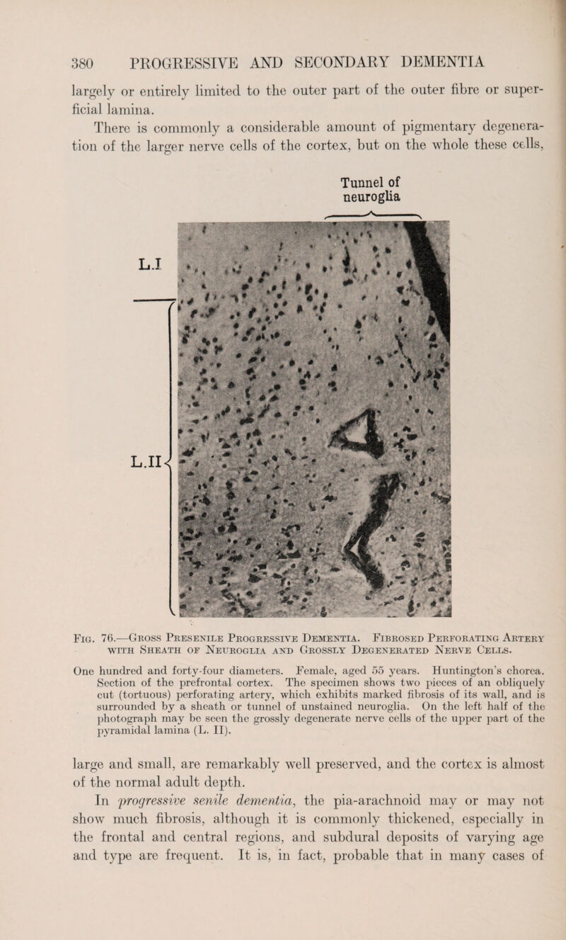 largely or entirely limited to the outer part of the outer fibre or super¬ ficial lamina. There is commonly a considerable amount of pigmentary degenera¬ tion of the larger nerve cells of the cortex, but on the whole these cells, Tunnel of neuroglia Fig. 76.—Gross Presenile Progressive Dementia. Fibrosed Perforating Artery with Sheath of Neuroglia and Grossly Degenerated Nerve Cells. One hundred and forty-four diameters. Female, aged 55 years. Huntington’s chorea. Section of the prefrontal cortex. The specimen shows two pieces of an obliquely cut (tortuous) perforating artery, which exhibits marked fibrosis of its wall, and is surrounded by a sheath or tunnel of unstained neuroglia. On the left half of the photograph may be seen the grossly degenerate nerve cells of the upper part of the pyramidal lamina (L. II). large and small, are remarkably well preserved, and the cortex is almost of the normal adult depth. In progressive senile dementia, the pia-arachnoid may or may not show much fibrosis, although it is commonly thickened, especially in the frontal and central regions, and subdural deposits of varying age and type are frequent. It is, in fact, probable that in many cases of
