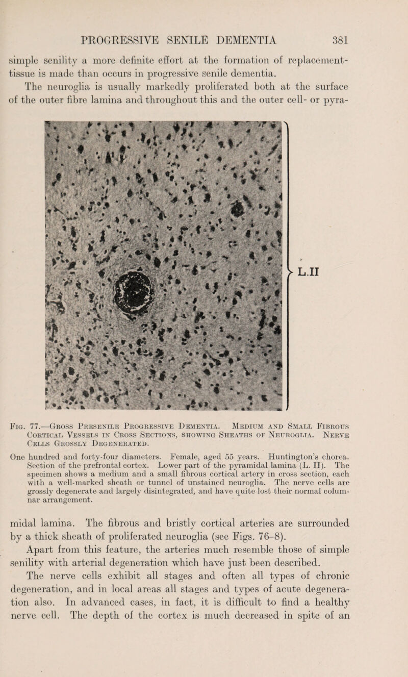 simple senility a more definite effort at the formation of replacement- tissue is made than occurs in progressive senile dementia. The neuroglia is usually markedly proliferated both at the surface of the outer fibre lamina and throughout this and the outer cell- or pyra- Fig. 77.—Gross Presenile Progressive Dementia. Medium and Small Fibrous Cortical Vessels in Cross Sections, showing Sheaths of Neuroglia. Nerve Cells Grossly Degenerated. One hundred and forty-four diameters. Female, aged 55 years. Huntington’s chorea. Section of the prefrontal cortex. Lower part of the pyramidal lamina (L. II). The specimen shows a medium and a small fibrous cortical artery in cross section, each with a well-marked sheath or tunnel of unstained neuroglia. The nerve cells are grossly degenerate and largely disintegrated, and have quite lost their normal colum¬ nar arrangement. midal lamina. The fibrous and bristly cortical arteries are surrounded by a thick sheath of proliferated neuroglia (see Figs. 76-8). Apart from this feature, the arteries much resemble those of simple senility with arterial degeneration which have just been described. The nerve cells exhibit all stages and often all types of chronic degeneration, and in local areas all stages and types of acute degenera¬ tion also. In advanced cases, in fact, it is difficult to find a healthy nerve cell. The depth of the cortex is much decreased in spite of an