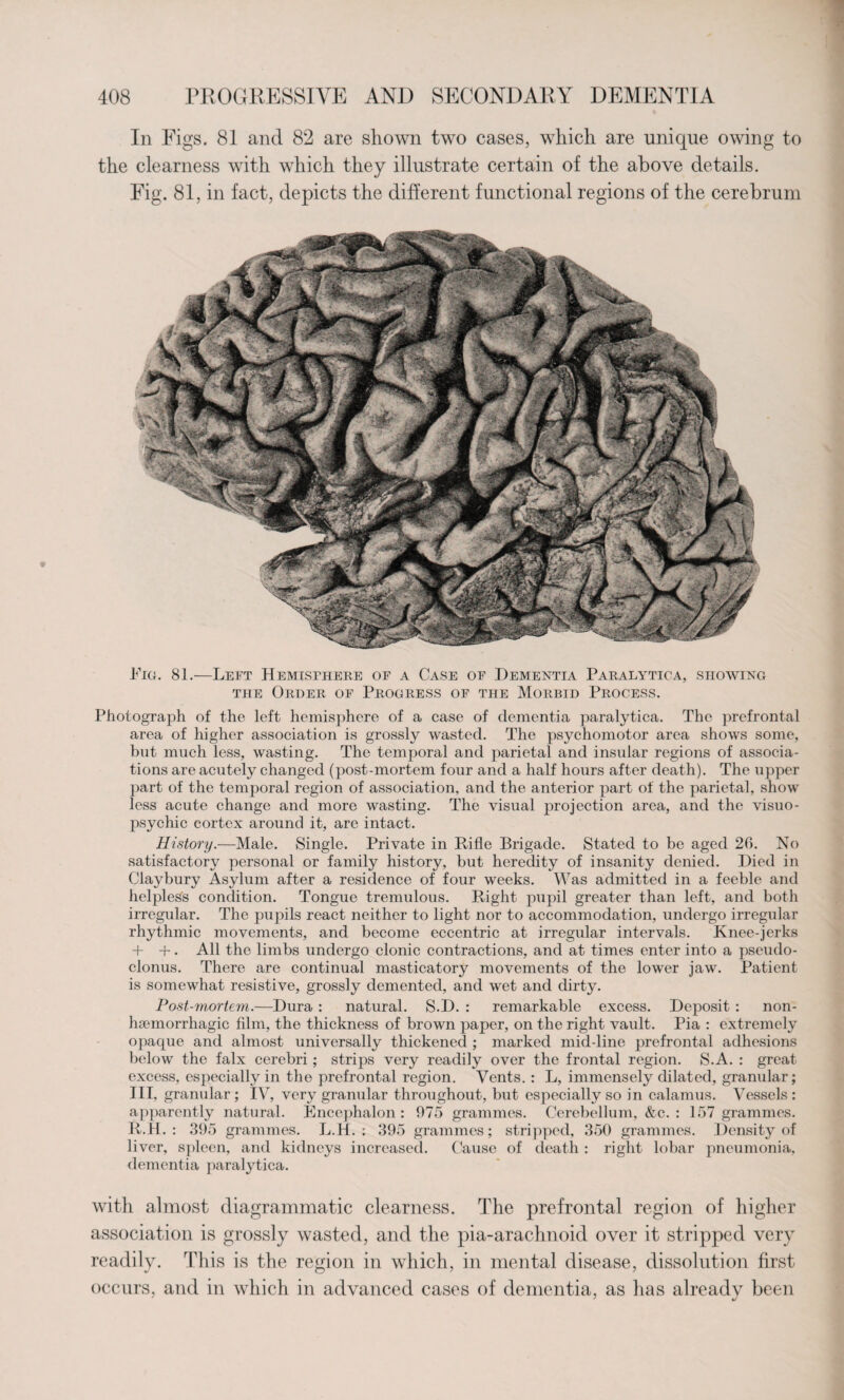 In Figs. 81 and 82 are shown two cases, which are unique owing to the clearness with which they illustrate certain of the above details. Fig. 81, in fact, depicts the different functional regions of the cerebrum Fig. 81.—Left Hemisfhere of a Case of Dementia Paralytica, showing the Order of Progress of the Morbid Process. Photograph of the left hemisphere of a case of dementia paralytica. The prefrontal area of higher association is grossly wasted. The psychomotor area shows some, but much less, wasting. The temporal and parietaf and insular regions of associa¬ tions are acutely changed (post-mortem four and a half hours after death). The upper part of the temporal region of association, and the anterior part of the parietal, show less acute change and more wasting. The visual projection area, and the visuo- psychic cortex around it, are intact. History.—Male. Single. Private in Rifle Brigade. Stated to be aged 26. No satisfactory personal or family history, but heredity of insanity denied. Died in Claybury Asylum after a residence of four weeks. Was admitted in a feeble and helpless condition. Tongue tremulous. Right pupil greater than left, and both irregular. The pupils react neither to light nor to accommodation, undergo irregular rhythmic movements, and become eccentric at irregular intervals. Knee-jerks + +. All the limbs undergo clonic contractions, and at times enter into a pseudo¬ clonus. There are continual masticatory movements of the lower jaw. Patient is somewhat resistive, grossly demented, and wet and dirty. Post-mortem.—Dura : natural. S.D. : remarkable excess. Deposit : non- hsemorrhagic film, the thickness of brown paper, on the right vault. Pia : extremely opaque and almost universally thickened ; marked mid-line prefrontal adhesions below the falx cerebri; strips very readily over the frontal region. S.A. : great excess, especially in the prefrontal region. Vents. : L, immensely dilated, granular; III, granular; IV, very granular throughout, but especially so in calamus. Vessels : apparently natural. Encephalon : 975 grammes. Cerebellum, &c. : 157 grammes. R.H. : 395 grammes. L.H. ; 395 grammes; stripped, 350 grammes. Density of liver, spleen, and kidneys increased. Cause of death : right lobar pneumonia, dementia paralytica. with almost diagrammatic clearness. The prefrontal region of higher association is grossly wasted, and the pia-arachnoid over it stripped very readily. This is the region in which, in mental disease, dissolution first occurs, and in which in advanced cases of dementia, as has alreadv been