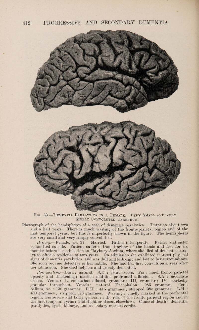 Fig. 83.—Dementia Paralytica in a Female. Very Small and very Simply Convoluted Cerebrum. Photograph of the hemispheres of a case of dementia paralytica. Duration about two and a half years. There is much wasting of the fronto-parietal region and of the first temporal gyrus, but this is imperfectly shown in the figure. The hemispheres are very small and very simply convoluted. History.—Female, set. 37. Married. Father intemperate. Father and sister committed suicide. Patient suffered from tingling of the hands and feet for six months before her admission to Claybury Asylum, where she died of dementia para¬ lytica after a residence of two years. On admission she exhibited marked physical signs of dementia paralytica, and was dull and lethargic and lost to her surroundings. She soon became defective in her habits. She had her first convulsion a year after her admission. She died helpless and grossly demented. Post-mortem.—Dura : natural. S.D. : great excess. Pia : much fronto-parietal opacity and thickening; marked mid-line prefrontal adhesions. S.A. : moderate excess. Vents. : L, somewhat dilated, granular; III, granular; IV, markedly granular throughout. Vessels : natural. Encephalon : 985 grammes. Cere¬ bellum, &c. : 138 grammes. R.H. : 415 grammes; stripped 385 grammes. L.H.: 400 grammes ; stripped, 373 grammes. Wasting : chiefly marked in the prefrontal region, less severe and fairly general in the rest of the fronto-parietal region and in the first temporal gyrus ; and slight or absent elsewhere. Cause of death : dementia paralytica, cystic kidneys, and secondary morbus cordis.