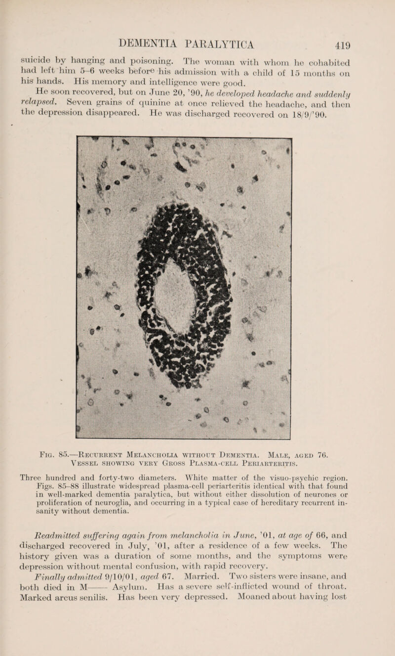 suicide by hanging and poisoning. The woman with whom ho cohabited had left him 5-6 weeks before his admission with a child of 15 months on his hands. His memory and intelligence were good. He soon recovered, but on June 20, ’90, he developed headache and suddenly relapsed. Seven grains of quinine at once relieved the headache, and then the depression disappeared. He was discharged recovered on 18/9/’90. Fig. 85.—Recurrent Melancholia without Dementia. Male, aged 76. Vessel showing very Gross Plasma-cell Periarteritis. Three hundred and forty-two diameters. White matter of the visuo-psychic region. Figs. 85-88 illustrate widespread plasma-cell periarteritis identical with that found in well-marked dementia paralytica, but without either dissolution of neurones or proliferation of neuroglia, and occurring in a typical case of hereditary recurrent in¬ sanity without dementia. Readmitted suffering again from melancholia in June, ’01, at age of 66, and discharged recovered in July, ’01, after a residence of a few weeks. The history given was a duration of some months, and the symptoms were depression without mental confusion, with rapid recovery. Finally admitted 9/10/01, aged 67. Married. Two sisters were insane, and both died in M-Asylum. Has a severe self-inflicted wound of throat. Marked arcus senilis. Has been very depressed. Moaned about having lost