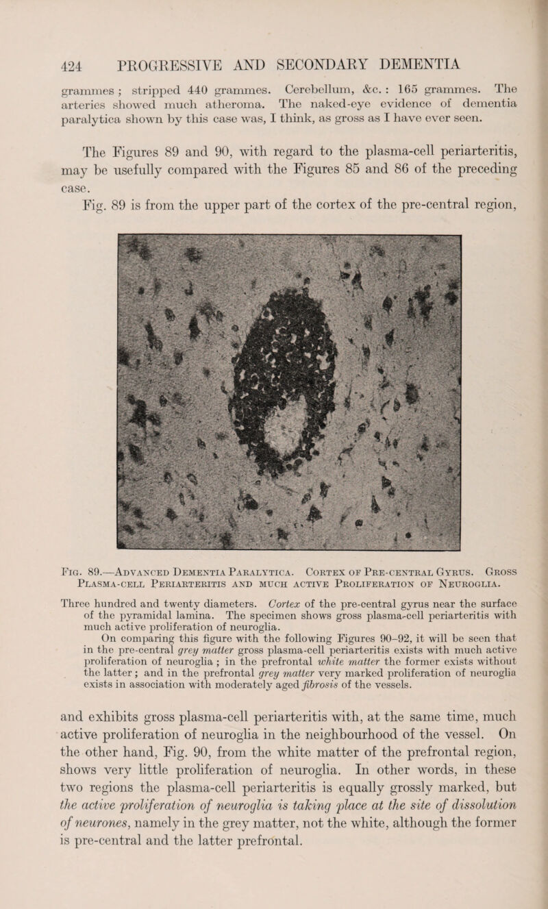 grammes ; stripped 440 grammes. Cerebellum, &c. : 165 grammes. The arteries showed much atheroma. The naked-eye evidence of dementia paralytica shown by this case was, I think, as gross as I have ever seen. The Figures 89 and 90, with regard to the plasma-cell periarteritis, may be usefully compared with the Figures 85 and 86 of the preceding case. Fig. 89 is from the upper part of the cortex of the pre-central region, Fig. 89.—Advanced Dementia Paralytica. Cortex of Pre-central Gyrus. Gross Plasma-cell Periarteritis and much active Proliferation of Neuroglia. Three hundred and twenty diameters. Cortex of the pre-central gyrus near the surface of the pyramidal lamina. The specimen shows gross plasma-cell periarteritis with much active proliferation of neuroglia. On comparing this figure with the following Figures 90-92, it will be seen that in the pre-central grey matter gross plasma-cell periarteritis exists with much active proliferation of neuroglia ; in the prefrontal white matter the former exists without the latter; and in the prefrontal grey matter very marked proliferation of neuroglia exists in association with moderately aged fibrosis of the vessels. and exhibits gross plasma-cell periarteritis with, at the same time, much active proliferation of neuroglia in the neighbourhood of the vessel. On the other hand, Fig. 90, from the white matter of the prefrontal region, shows very little proliferation of neuroglia. In other words, in these two regions the plasma-cell periarteritis is equally grossly marked, but the active proliferation of neuroglia is talcing place at the site of dissolution of neurones, namely in the grey matter, not the white, although the former is pre-central and the latter prefrontal.
