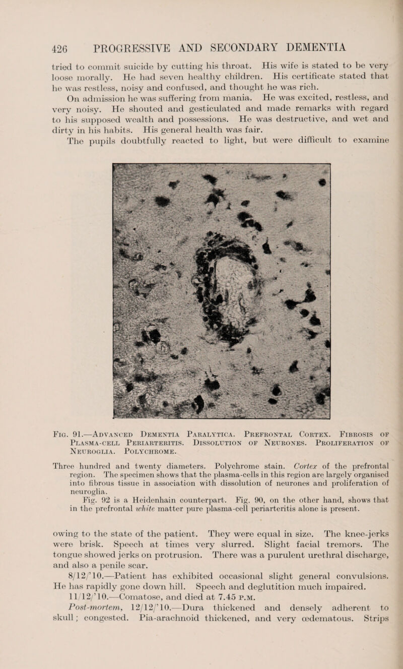 tried to commit suicide by cutting his throat. His wife is stated to be very loose morally. He had seven healthy children. His certificate stated that he was restless, noisy and confused, and thought he was rich. On admission he was suffering from mania. He was excited, restless, and very noisy. He shouted and gesticulated and made remarks with regard to his supposed wealth and possessions. He was destructive, and wet and dirty in his habits. His general health was fair. The pupils doubtfully reacted to light, but were difficult to examine Fig. 91.—Advanced Dementia Paralytica. Prefrontal Cortex. Fibrosis of Plasma-cell Periarteritis. Dissolution of Neurones. Proliferation of Neuroglia. Polychrome. Three hundred and twenty diameters. Polychrome stain. Cortex of the prefrontal region. The specimen shows that the plasma-cells in this region are largely organised into fibrous tissue in association with dissolution of neurones and proliferation of neuroglia. Fig. 92 is a Heidenhain counterpart. Fig. 90, on the other hand, shows that in the prefrontal white matter pure plasma-cell periarteritis alone is present. owing to the state of the patient. They were equal in size. The knee-jerks were brisk. Speech at times very shirred. Slight facial tremors. The tongue showed jerks on protrusion. There was a purulent urethral discharge, and also a penile scar. 8/12/’10.—Patient has exhibited occasional slight general convulsions. He has rapidly gone down hill. Speech and deglutition much impaired. ll/12/’lO.—Comatose, and died at 7.45 p.m. Post-mortem, 12/12/’ 10.-—Dura thickened and densely adherent to skull; congested. Pia-arachnoid thickened, and very oedematous. Strips