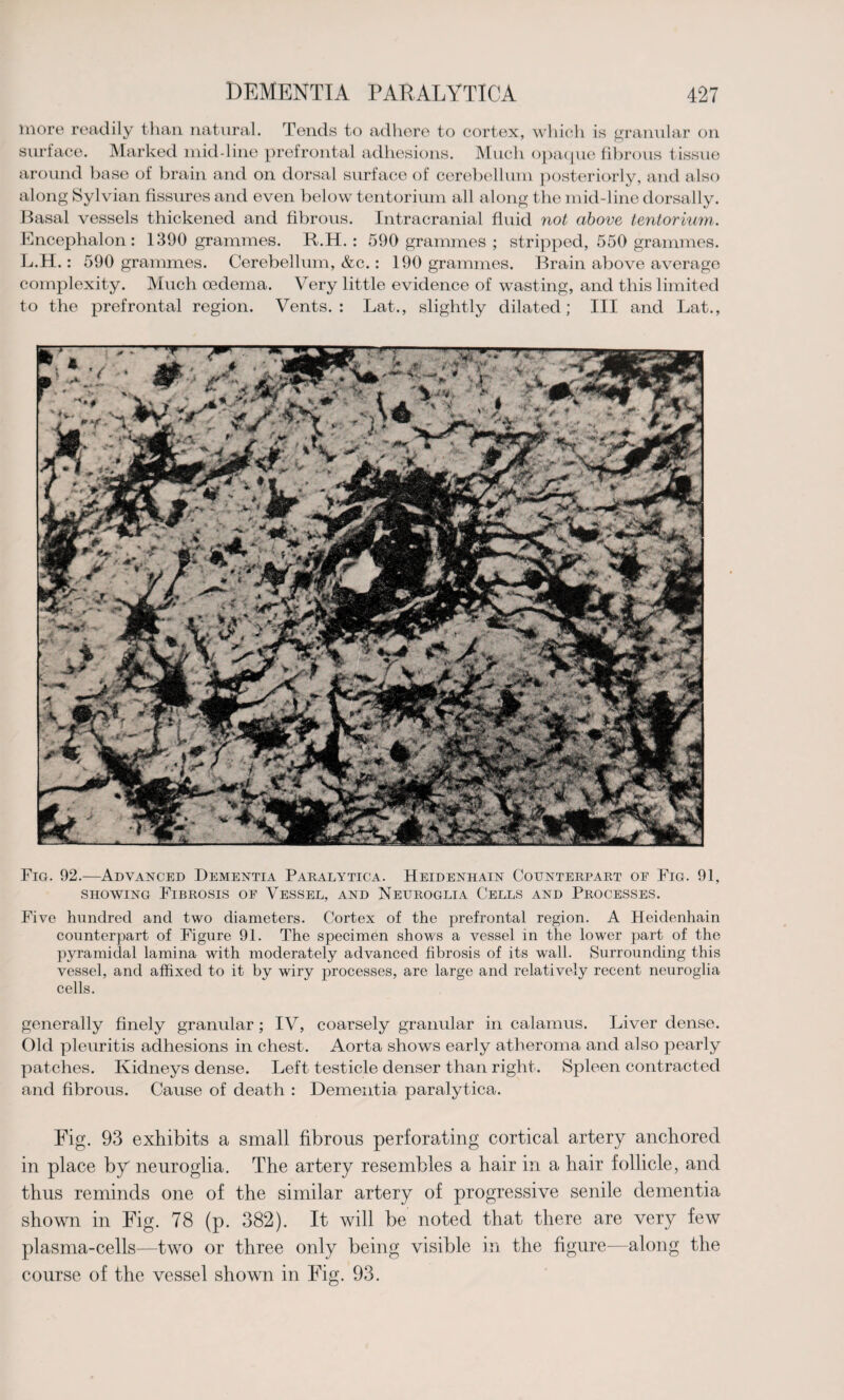 more readily than natural. Tends to adhere to cortex, which is granular on surface. Marked mid-line prefrontal adhesions. Much opaque fibrous tissue around base of brain and on dorsal surface of cerebellum posteriorly, and also along Sylvian fissures and even below tentorium all along the mid-line dorsally. Basal vessels thickened and fibrous. Intracranial fluid not above tentorium. Encephalon: 1390 grammes. R.H. : 590 grammes ; stripped, 550 grammes. L.H.: 590 grammes. Cerebellum, &c.: 190 grammes. Brain above average complexity. Much oedema. Very little evidence of wasting, and this limited to the prefrontal region. Vents.: Lat., slightly dilated; III and Lat., Fig. 92.—Advanced Dementia Paralytica. Heidenhain Counterpart of Fig. 91, showing Fibrosis of Vessel, and Neuroglia Cells and Processes. Five hundred and two diameters. Cortex of the prefrontal region. A Heidenhain counterpart of Figure 91. The specimen shows a vessel in the lower part of the pyramidal lamina with moderately advanced fibrosis of its wall. Surrounding this vessel, and affixed to it by wiry processes, are large and relatively recent neuroglia cells. generally finely granular; IV, coarsely granular in calamus. Liver dense. Old pleuritis adhesions in chest. Aorta shows early atheroma and also pearly patches. Kidneys dense. Left testicle denser than right. Spleen contracted and fibrous. Cause of death : Dementia paralytica. Fig. 93 exhibits a small fibrous perforating cortical artery anchored in place by neuroglia. The artery resembles a hair in a hair follicle, and thus reminds one of the similar artery of progressive senile dementia shown in Fig. 78 (p. 382). It will be noted that there are very few plasma-cells—two or three only being visible in the figure—along the course of the vessel shown in Fig. 93.