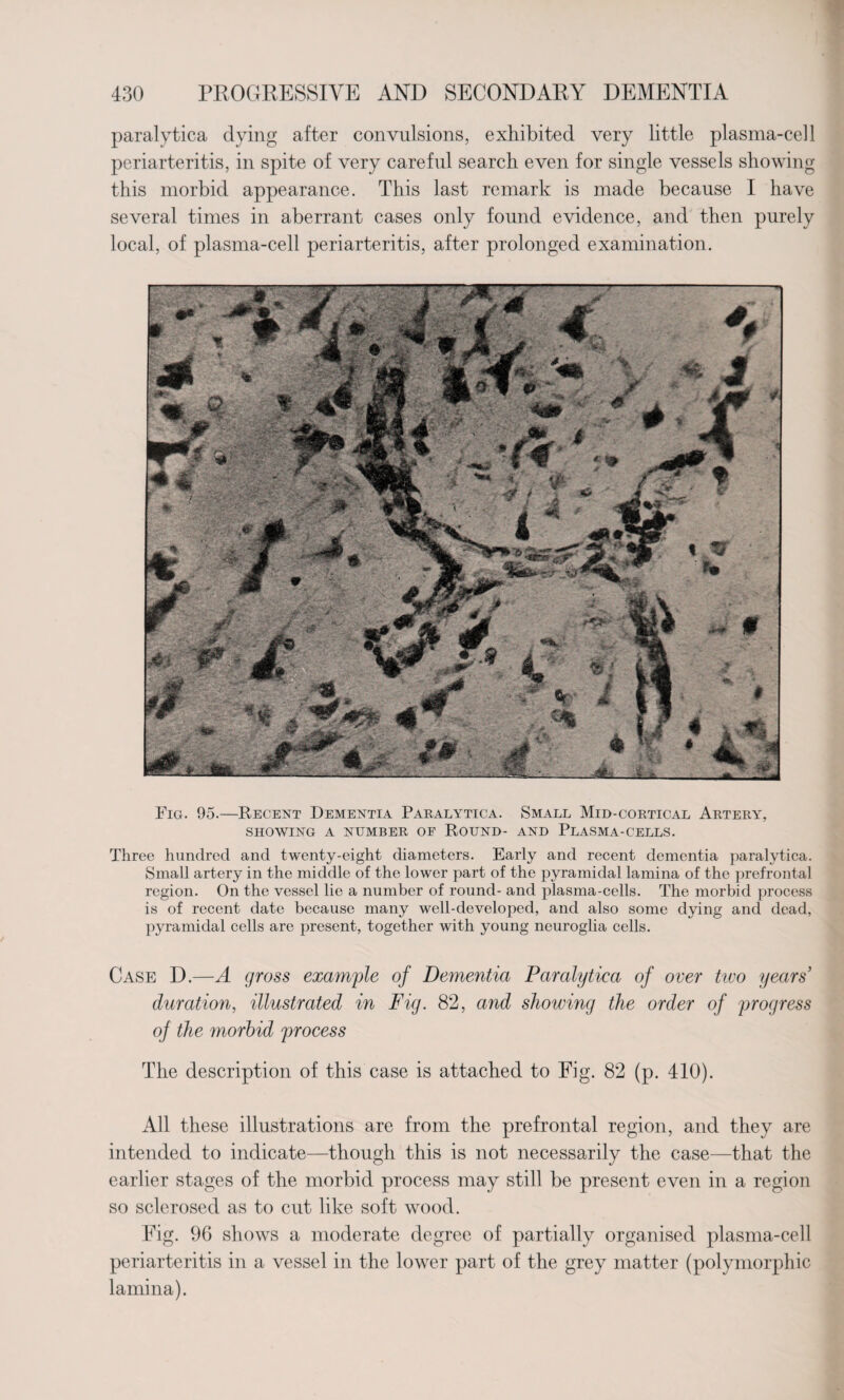 paralytica dying after convulsions, exhibited very little plasma-cell periarteritis, in spite of very careful search even for single vessels showing this morbid appearance. This last remark is made because I have several times in aberrant cases only found evidence, and then purely local, of plasma-cell periarteritis, after prolonged examination. Fig. 95.—Recent Dementia Paralytica. Small Mid-cortical Artery, SHOWING A NUMBER OF ROUND- AND PLASMA-CELLS. Three hundred and twenty-eight diameters. Early and recent dementia paralytica. Small artery in the middle of the lower part of the pyramidal lamina of the prefrontal region. On the vessel lie a number of round- and plasma-cells. The morbid process is of recent date because many well-developed, and also some dying and dead, pyramidal cells are present, together with young neuroglia cells. Case D.—A gross example of Dementia Paralytica of over two years' duration, illustrated in Fig. 82, and showing the order of progress of the morbid process The description of this case is attached to Fig. 82 (p. 410). All these illustrations are from the prefrontal region, and they are intended to indicate—though this is not necessarily the case—that the earlier stages of the morbid process may still be present even in a region so sclerosed as to cut like soft wood. Fig. 96 shows a moderate degree of partially organised plasma-cell periarteritis in a vessel in the lower part of the grey matter (polymorphic lamina).