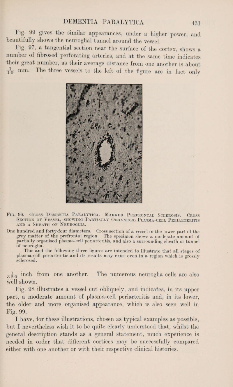 ig. 99 gives the similar appearances, under a higher power, and beautifully shows the neuroglial tunnel around the vessel. hig. 97, a tangential section near the surface of the cortex, shows a number of fibrosed perforating arteries, and at the same time indicates their great number, as their average distance from one another is about tV mm- Tlie three vessels to the left of the figure are in fact only Fig. 06.—Gross Dementia Paralytica. Marked Prefrontal Sclerosis. Cross Section of Vessel, showing Partially Organised Plasma-cell Periarteritis and a Sheath of Neuroglia. One hundred and forty-four diameters. Cross section of a vessel in the lower part of the grey matter of the prefrontal region. The specimen shows a moderate amount of partially organised plasma-cell periarteritis, and also a surrounding sheath or tunnel of neuroglia. This and the following three figures are intended to illustrate that all stages of plasma-cell periarteritis and its results may exist even in a region which is grossly sclerosed. gY() inch from one another. The numerous neuroglia cells are also well shown. Fig. 98 illustrates a vessel cut obliquely, and indicates, in its upper part, a moderate amount of plasma-cell periarteritis and, in its lower, the older and more organised appearance, which is also seen well in Fig. 99. I have, for these illustrations, chosen as typical examples as possible, but I nevertheless wish it to be quite clearly understood that, whilst the general description stands as a general statement, much experience is needed in order that different cortices may be successfully compared either with one another or with their respective clinical histories.