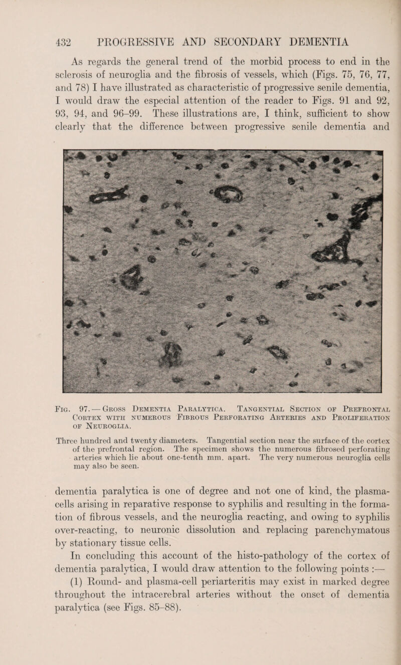 As regards the general trend of the morbid process to end in the sclerosis of neuroglia and the fibrosis of vessels, which (Figs. 75, 76, 77, and 78) I have illustrated as characteristic of progressive senile dementia, I would draw the especial attention of the reader to Figs. 91 and 92, 93, 94, and 96-99. These illustrations are, I think, sufficient to show clearly that the difference between progressive senile dementia and Fig. 97. — Gross Dementia Paralytica. Tangential Section of Prefrontal Cortex with numerous Fibrous Perforating Arteries and Proliferation of Neuroglia. Three hundred and twenty diameters. Tangential section near the surface of the cortex of the prefrontal region. The specimen shows the numerous fibrosed perforating arteries which lie about one-tenth mm. apart. The very numerous neuroglia cells may also be seen. dementia paralytica is one of degree and not one of kind, the plasma- cells arising in reparative response to syphilis and resulting in the forma¬ tion of fibrous vessels, and the neuroglia reacting, and owing to syphilis over-reacting, to neuronic dissolution and replacing parenchymatous by stationary tissue cells. In concluding this account of the histo-pathology of the cortex of dementia paralytica, I would draw attention to the following points :— (1) Round- and plasma-cell periarteritis may exist in marked degree throughout the intracerebral arteries without the onset of dementia paralytica (see Figs. 85-88).