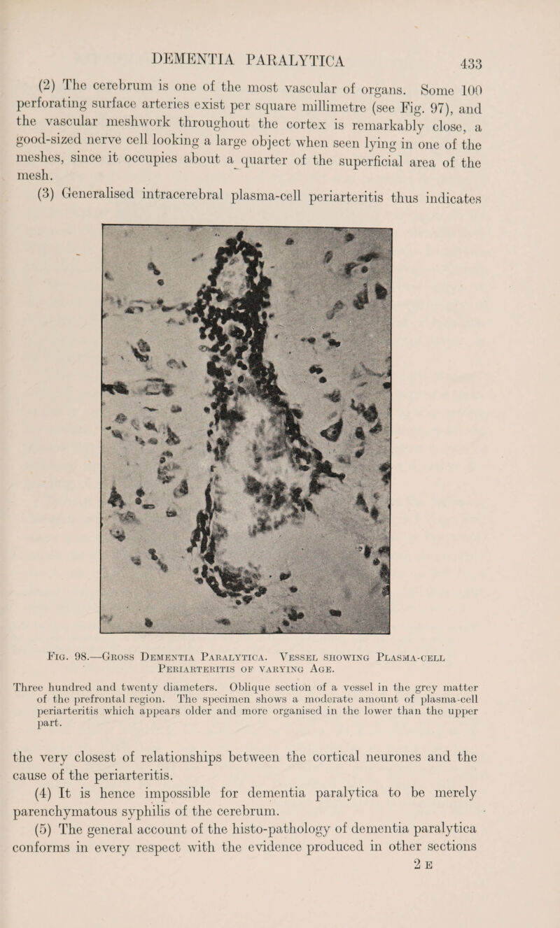(2) The cerebrum is one of the most vascular of organs. Some 100 perforating surface arteries exist per square millimetre (see Fig. 97), and the vascular mesh work throughout the cortex is remarkably close, a good-sized nerve cell looking a large object when seen lying in one of the meshes, since it occupies about a quarter of the superficial area of the mesh. (2) Generalised intracerebral plasma-cell periarteritis thus indicates Fig. 98.—Gross Dementia Paralytica. Vessel showing Plasma-cell Periarteritis of varying Age. Three hundred and twenty diameters. Oblique section of a vessel in the grey matter of the prefrontal region. The specimen shows a moderate amount of plasma-cell periarteritis which appears older and more organised in the lower than the upper part. the very closest of relationships between the cortical neurones and the cause of the periarteritis. (4) It is hence impossible for dementia paralytica to be merely parenchymatous syphilis of the cerebrum. (5) The general account of the histo-pathology of dementia paralytica conforms in every respect with the evidence produced in other sections