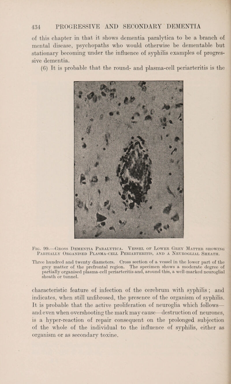 of this chapter in that it shows dementia paralytica to be a branch of mental disease, psychopaths who would otherwise be dementable but stationary becoming under the influence of syphilis examples of progres¬ sive dementia. (6) It is probable that the round- and plasma-cell periarteritis is the Fig. 99.—Gross Dementia Paralytica. Vessel oe Lower Grey Matter showing Partially Organised Plasma-cell Periarteritis, and a Neuroglial Sheath. Three hundred and twenty diameters. Cross section of a vessel in the lower part of the grey matter of the prefrontal region. The specimen shows a moderate degree of partially organised plasma-cell periarteritis and, around this, a well-marked neuroglial sheath or tunnel. characteristic feature of infection of the cerebrum with syphilis ; and indicates, when still unfibrosed, the presence of the organism of syphilis. It is probable that the active proliferation of neuroglia which follows— and even when overshooting the mark may cause—destruction of neurones, is a hyper-reaction of repair consequent on the prolonged subjection of the whole of the individual to the influence of syphilis, either as organism or as secondary toxine.