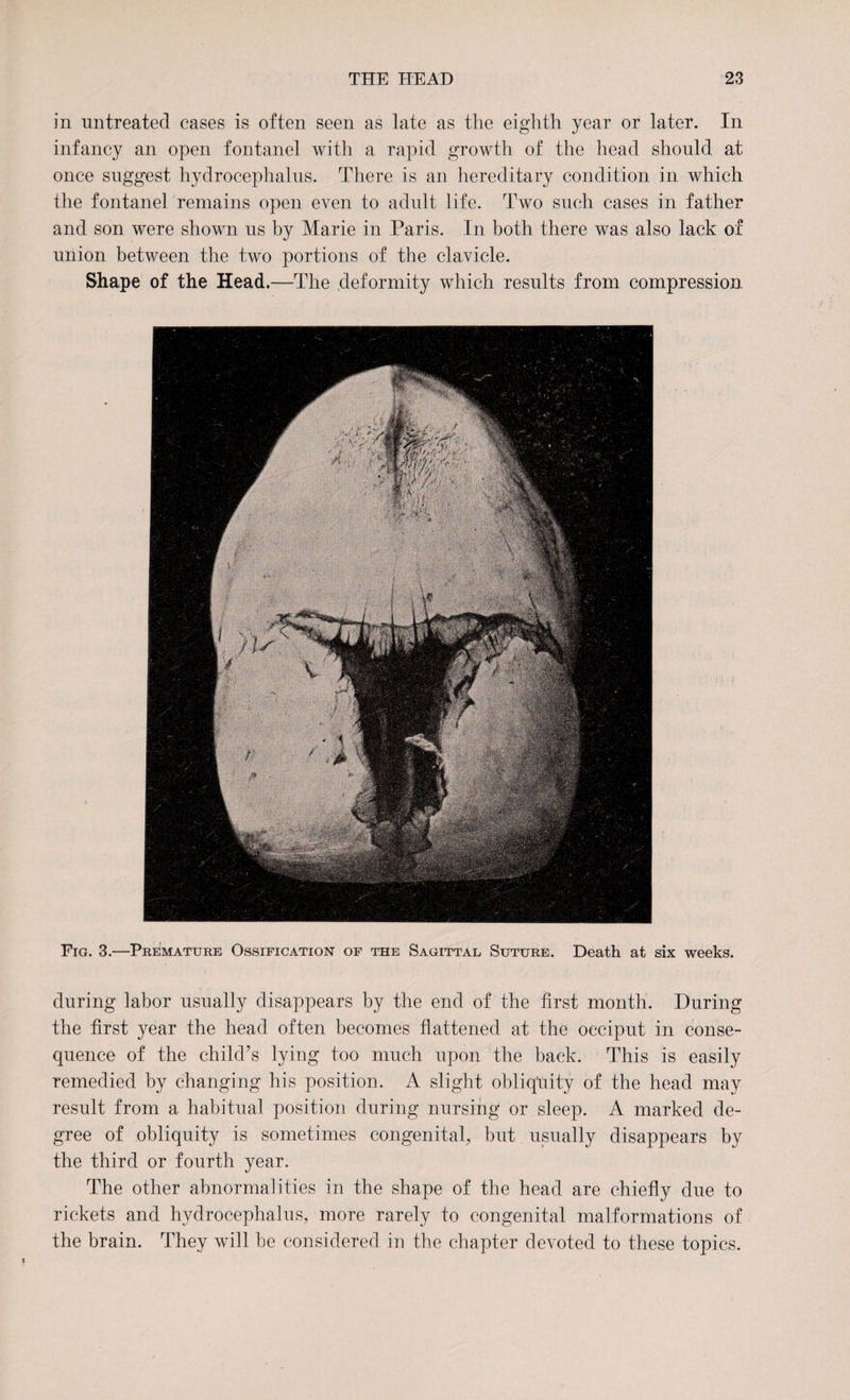 in untreated cases is often seen as late as the eighth year or later. In infancy an open fontanel with a rapid growth of the head should at once suggest hydrocephalus. There is an hereditary condition in which the fontanel remains open even to adult life. Two such cases in father and son were shown us by Marie in Paris. In both there was also lack of union between the two portions of the clavicle. Shape of the Head.—The deformity which results from compression Fig. 3.—Premature Ossification of the Sagittal Suture. Death at six weeks. during labor usually disappears by the end of the first month. During the first year the head often becomes flattened at the occiput in conse¬ quence of the child’s lying too much upon the back. This is easily remedied by changing his position. A slight obliquity of the head may result from a habitual position during nursing or sleep. A marked de¬ gree of obliquity is sometimes congenital, but usually disappears by the third or fourth year. The other abnormalities in the shape of the head are chiefly due to rickets and hydrocephalus, more rarely to congenital malformations of the brain. They will he considered in the chapter devoted to these topics.