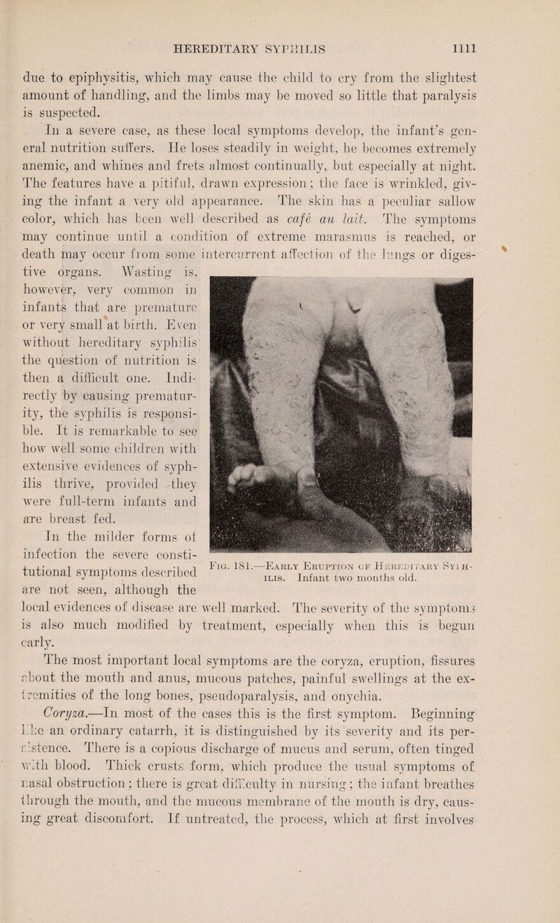 clue to epiphysitis, which may cause the child to cry from the slightest amount of handling, and the limbs may be moved so little that paralysis is suspected. In a severe case, as these local symptoms develop, the infant’s gen¬ eral nutrition suffers. He loses steadily in weight, he becomes extremely anemic, and whines and frets almost continually, but especially at night. The features have a pitiful, drawn expression ; the face is wrinkled, giv¬ ing the infant a very old appearance. The skin has a peculiar sallow color, which has been well described as cafe au Icdt. The symptoms may continue until a condition of extreme marasmus is reached, or death may occur from some intercurrent affection of the lungs or diges¬ tive organs. Wasting is, however, very common in infants that are premature or very small at birth. Even without hereditary syphilis1 the question of nutrition is then a difficult one. Indi¬ rectly by causing prematur¬ ity, the syphilis is responsi¬ ble. It is remarkable to see how well some children with extensive evidences of syph¬ ilis thrive, provided -they were full-term infants and are breast fed. In the milder forms of infection the severe consti¬ tutional symptoms described are not seen, although the local evidences of disease are well marked. The severity of the symptoms is also much modified by treatment, especially when this is begun early. The most important local symptoms are the coryza, eruption, fissures about the mouth and anus, mucous patches, painful swellings at the ex¬ tremities of the long bones, pseudoparalysis, and onychia. Coryza.—In most of the cases this is the first symptom. Beginning hke an ordinary catarrh, it is distinguished by its severity and its per- rustence. There is a copious discharge of mucus and serum, often tinged wdh blood. Thick crusts form, which produce the usual symptoms of nasal obstruction; there is great difficulty in nursing; the infant breathes through the mouth, and the mucous membrane of the mouth is dry, caus¬ ing great discomfort. If untreated, the process, which at first involves Fig. 181.—Early Eruption of Hereditary Syih- ilis. Infant two months old.