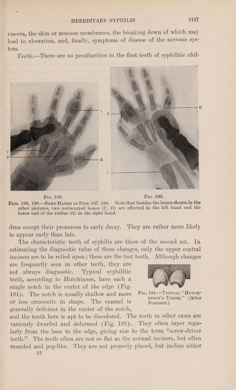 HIT viscera, the skin or mncons membranes, the breaking down' of which may lead to ulceration, and, finally, symptoms of disease of the nervous sys¬ tem. Teeth.—There are no peculiarities in the first teeth of syphilitic chil- Fig. 189. Fig. 190. Figs. 189, 190.—Same Hands as Figs. 187, 188. Note that besides the bones shown in the other pictures, two metacarpal bones (C, D) are affected in the left hand and the lower end of the radius (G) in the right hand. dren except their proneness to early decay. They are rather more likely to appear early than late. The characteristic teeth of syphilis are those of the second set. In estimating the diagnostic value of these changes, only the upper central incisors are to be relied upon; these are the test teeth. Although changes are frequently seen in other teeth, they are not always diagnostic. Typical syphilitic teeth, according to Hutchinson, have each a single notch in the center of the edge (Fig. 191). The notch is usually shallow and more or less crescentic in shape. The enamel is generally deficient in the center of the notch, and the tooth here is apt to be discolored. The teeth in other cases are variously dwarfed and deformed (Fig. 192). They often taper regu¬ larly from the base to the edge, giving rise to the term “screw-driver teeth/’ The teeth often are not so flat as the normal incisors, but often rounded and peg-like. They are not properly placed, hut incline either 87 Fig. 191.—Typical “Hutch¬ inson’s Teeth.” (After Fournier.)