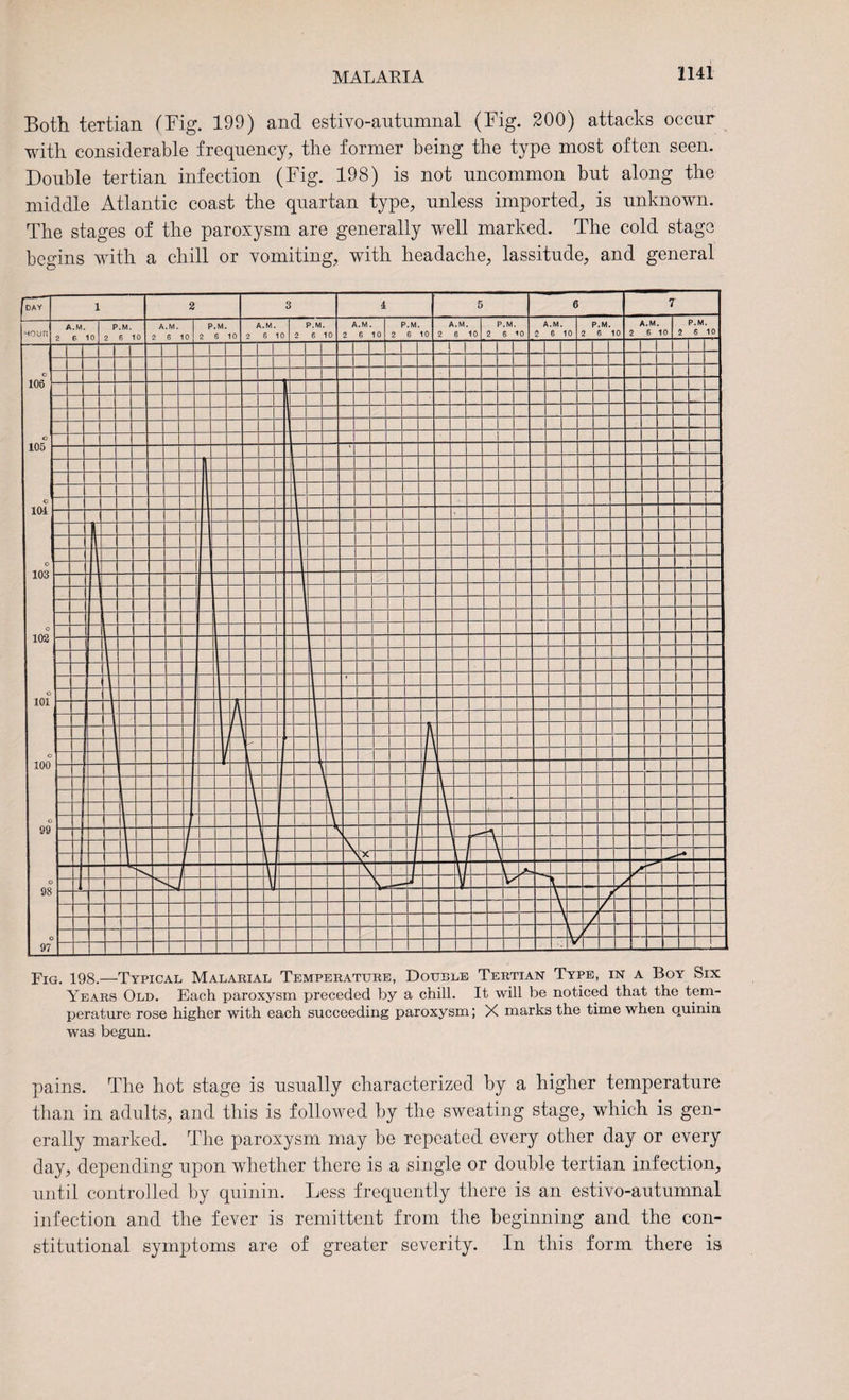 Both teTtian (Fig. 199) and estivo-antnmnal (Fig. 200) attacks occur with considerable frequency, the former being the type most often seen. Double tertian infection (Fig. 198) is not uncommon but along the middle Atlantic coast the quartan type, unless imported, is unknown. The stages of the paroxysm are generally well marked. The cold stage begins with a chill or vomiting, with headache, lassitude, and general pains. The hot stage is usually characterized by a higher temperature than in adults, and this is followed by the sweating stage, which is gen¬ erally marked. The paroxysm may be repeated every other day or every day, depending upon whether there is a single or double tertian infection, until controlled by quinin. Less frequently there is an estivo-autumnal infection and the fever is remittent from the beginning and the con¬ stitutional symptoms are of greater severity. In this form there is