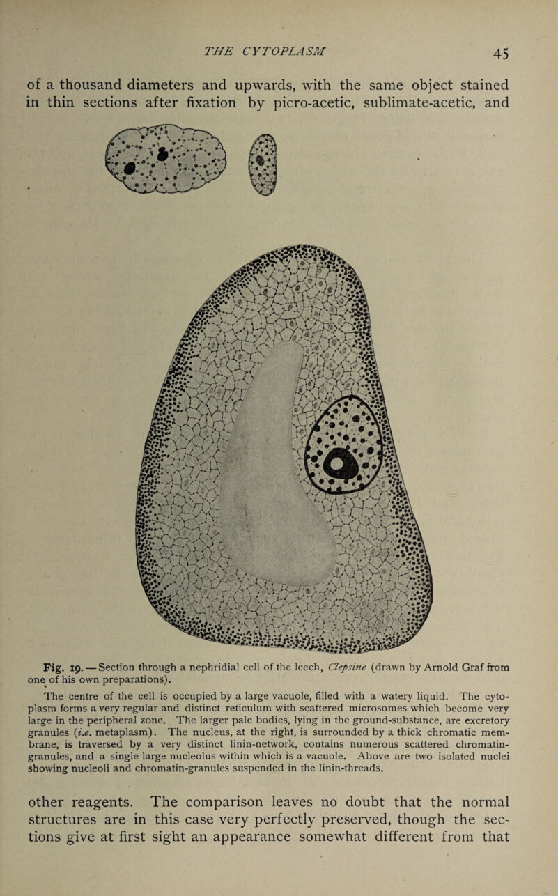 of a thousand diameters and upwards, with the same object stained in thin sections after fixation by picro-acetic, sublimate-acetic, and Fig. 19. — Section through a nephridial cell of the leech, Clepsine (drawn by Arnold Graf from one of his own preparations). The centre of the cell is occupied by a large vacuole, filled with a watery liquid. The cyto¬ plasm forms a very regular and distinct reticulum with scattered microsomes which become very large in the peripheral zone. The larger pale bodies, lying in the ground-substance, are excretory granules (i.e. metaplasm). The nucleus, at the right, is surrounded by a thick chromatic mem¬ brane, is traversed by a very distinct linin-network, contains numerous scattered chromatin- granules, and a single large nucleolus within which is a vacuole. Above are two isolated nuclei showing nucleoli and chromatin-granules suspended in the linin-threads. other reagents. The comparison leaves no doubt that the normal structures are in this case very perfectly preserved, though the sec¬ tions give at first sight an appearance somewhat different from that