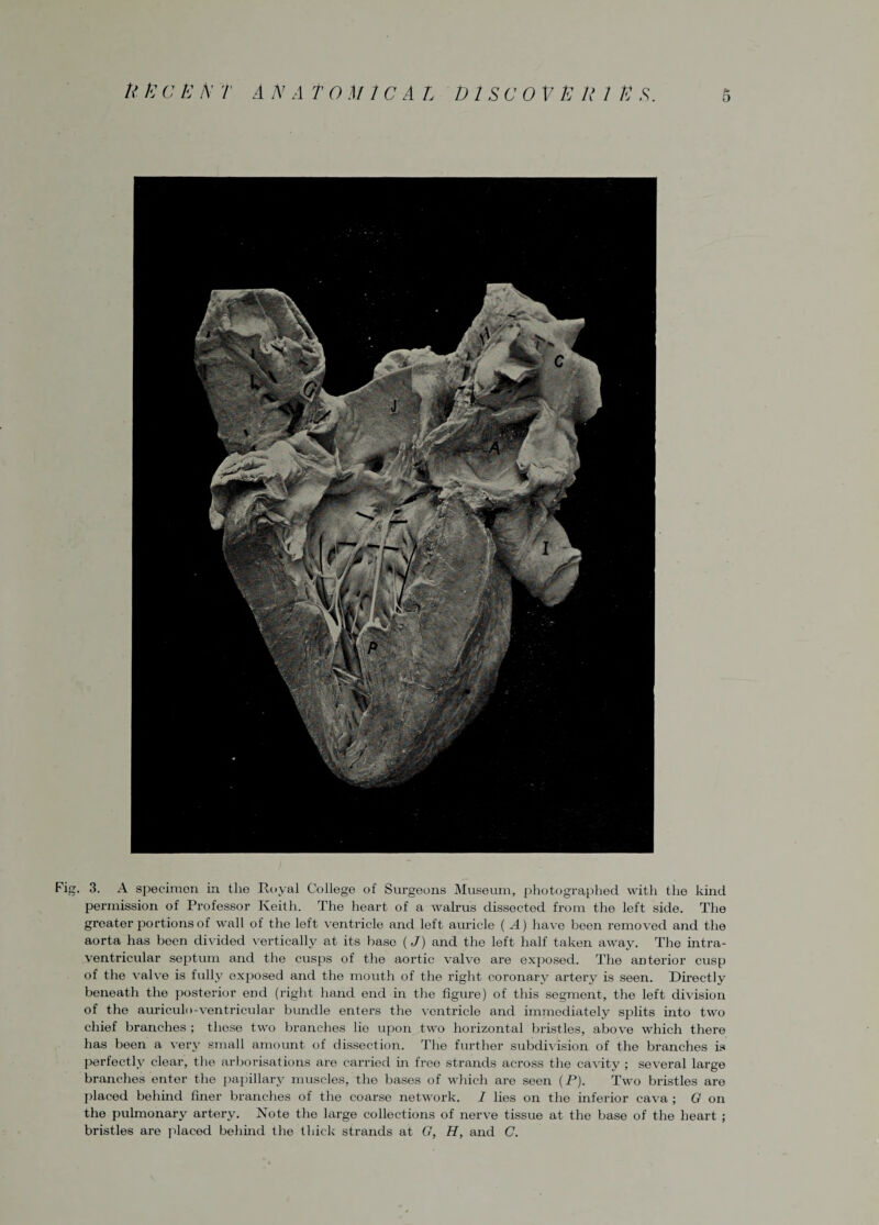 o Fig. 3. A specimen in the Koyal College of Surgeons Museum, photographed with the kind permission of Professor Keith. The heart of a walrus dissected from the left side. The greater portions of wall of the left ventricle and left auricle ( A) have been removed and the aorta has been divided vertically at its base (J) and the left half taken away. The intra¬ ventricular septum and the cusps of the aortic valve are exposed. The anterior cusp of the valve is fully exposed and the mouth of the right coronary artery is seen. Directly beneath the posterior end (right hand end in the figure) of this segment, the left division of the auriculo-ventricular bundle enters the ventricle and immediately splits into two chief branches ; those two branches lie upon two horizontal bristles, above which there has been a very small amount of dissection. The further subdivision of the branches is perfectly clear, the arborisations are carried in free strands across the cavity ; several large branches enter the papillary muscles, the bases of which are seen (P). Two bristles are placed behind finer branches of the coarse network. I lies on the inferior cava; G on the pulmonary artery. Note the large collections of nerve tissue at the base of the heart ; bristles are placed behind the thick strands at G, H, and C.