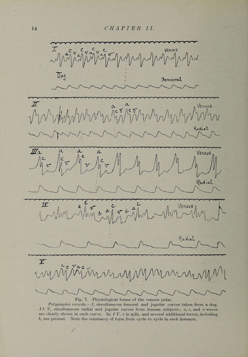 v v - w nr mrvy^^r- ^v^r*v'V'^rnr'^r\f^n/*~\(,nr*vnr,v*v,'V,nrnrir,nlr'v^v*‘v^'v,/v*^Vv~yT^ Fig. 7. Physiological forms of the venous pulse. Polygraphic records.—I, simultaneous femoral and jugular curves taken from a dog. 11- V, simultaneous radial and jugular curves from human subjects ; a, c, and v waves aro clearly shown in each curve. In I V, v is split, and several additional waves, including b, are present. Note the constancy of form from cycle to cycle in each instance.