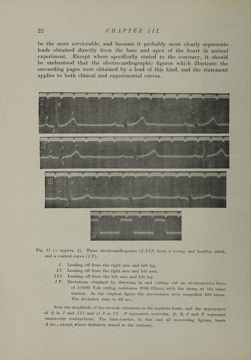 be the most serviceable, and because it probably most clearly represents leads obtained directly from the base and apex of the heart in animal experiment. Except where specifically stated to the contrary, it should be understood that the electrocardiographic figures which illustrate the succeeding pages were obtained by a lead of this kind, and the statement applies to both clinical and experimental curves. Fig. 11 (x approx, £). Three electrocardiograms (I-111) from a young and healthy adult, and a control curve (I V). I. Leading off from the right arm and left leg. II. Leading off from the right arm and left arm. III. Leading off from the left arm and left leg. I V. Deviations obtained by throwing hi and cutting out an electromotive force of 1/1000 Volt (string resistance 9!100 Ohms), with the string at the same tension. In the original figure the movements were magnified 410 tunes. The deviation time is -02 sec.. Note the amplitude of the several variations in the separate leads, and the appearance of Q in / and III and of S in II. P represents auricular, Q, K, S and T represent ventricular contractions. The time-marker, in this and all succeeding figures, beats •2 sec., except where definitely stated to the contrary.