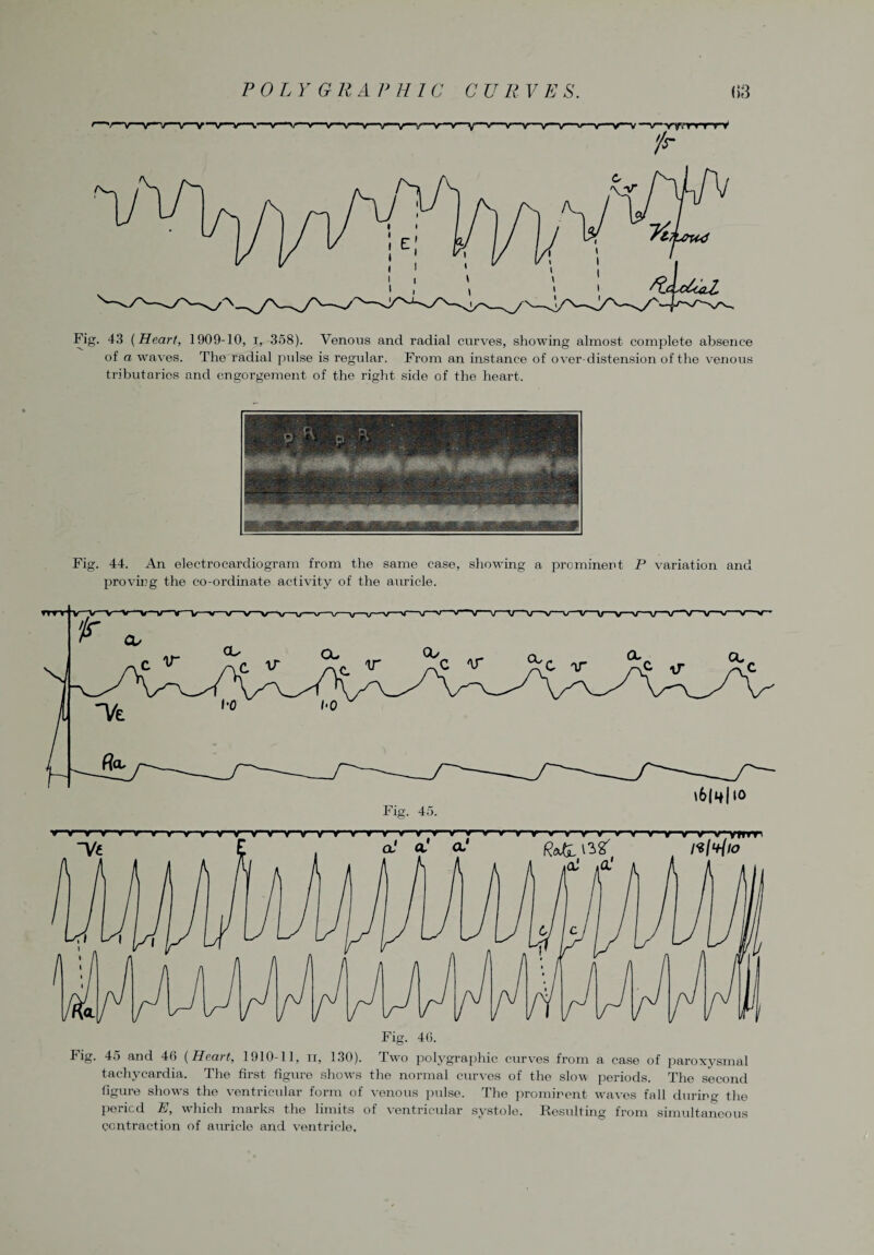 —\)—ryvrr-r-rV '/r Fig. 43 {Heart, 1909-10, i, 358). Venous and radial curves, showing almost complete absence of a waves. The radial pulse is regular. From an instance of over-distension of the venous tributaries and engorgement of the right side of the heart. Fig. 44. An electrocardiogram from the same case, showing a prominent P variation and proving the co-ordinate activity of the auricle. Fig. 40. Fig. 45 and 40 {Heart, 1910-11, ix, 130). Two polygraphic curves from a case of paroxysmal tachycardia. The first figure shows the normal curves of the slow periods. The second figure show's the ventricular form of venous pulse. The prominent waves fall during the period E, which marks the limits of ventricular systole. Resulting from simultaneous contraction of auricle and ventricle.