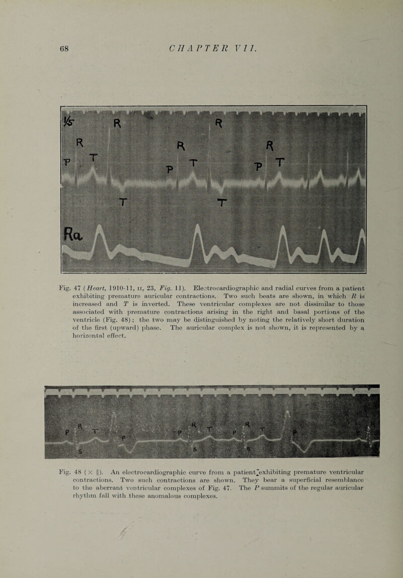 Fig. 47 (Heart, 1910-11, ir, 23, Fig. 11). Electrocardiographic and radial curves from a patient exhibiting premature auricular contractions. Two such beats are shown, in which R is increased and T is inverted. These ventricular complexes are not dissimilar to those associated with premature contractions arising in the right and basal portions of the ventricle (Fig. 48); the two may be distinguished by noting the relatively short duration of the first (upward) phase. The auricular complex is not shown, it is represented by a horizontal effect. Fig. 48 ( X fj). An electrocardiographic curve from a patient^exliibiting premature ventricular contractions. Two such contractions are shown. They bear a superficial resemblance to the aberrant ventricular complexes of Fig. 47. The P summits of the regular auricular rhythm fall with these anomalous complexes.