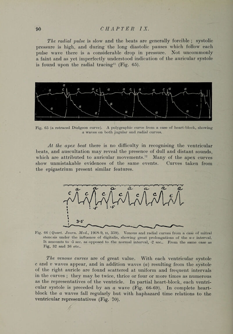 The radial pulse is slow and the beats are generally forcible ; systolic pressure is high, and during the long diastolic pauses which follow each pulse wave there is a considerable drop in pressure. Not uncommonly a faint and as yet imperfectly understood indication of the auricular systole is found upon the radial tracing (Fig. 65). Fig. 65 (a retraced Dudgeon curve). A polygraphic curve from a case of heart-block, showing a waves on both jugular and radial curves. At the apex heat there is no difficulty in recognising the ventricular beats, and auscultation may reveal the presence of dull and distant sounds, which are attributed to auricular movements.12 Many of the apex curves show unmistakable evidences of the same events. Curves taken from the epigastrium present similar features. Fig. 66 {Quart. Journ. Mad., 1908-9, 11, 359). Venous and radial curves from a case of mitral stenosis under the influence of digitalis, showing great prolongations of the a-c interval. It amounts to -5 sec. as opposed to the normal interval, •2 sec.. From the same case as Fig. 32 and 36 etc.. The venous curves are of great value. With each ventricular systole c and v waves appear, and in addition waves (a) resulting from the systole of the right auricle are found scattered at uniform and frequent intervals in the curves ; they may be twice, thrice or four or more times as numerous as the representatives of the ventricle. In partial heart-block, each ventri¬ cular systole is jfreceded by an a wave (Fig. 66-69). In complete heart- block the a waves fall regularly but with haphazard time relations to the ventricular representatives (Fig. 70).