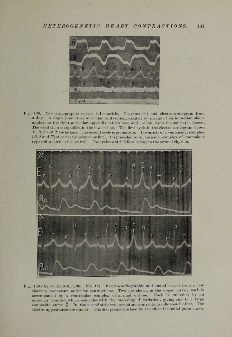 Fig. 108. Myocardiographic curves ( A = auricle, V = ventricle) and electrocardiogram from a dog. A single premature auricular contraction, excited by means of an induction shock applied to the right auricular appendix (at its base and 1-5 cm. from the sulcus) is shown. The excitation is signalled in the lowest lino. The first cycle in the electrocardiogram shows P, R, S and T variations. The second cycle is premature. It consists of a ventricular complex ( R, S and T) of perfectly normal outline ; it is preceded by an auricular complex of anomalous typo (bifurcated in the centre). The cycles which follow belong to the normal rhythm. Fig. 109 {Heart, 1909-10,1,300, Fig. 12). Electrocardiographic and radial curves from a case showing premature auricular contractions. Two are shown in the upper curve ; each is accompanied by a ventricular complex of normal outline. Each is preceded by an auricular complex which coincides with the preceding T variation, giving rise to a large composite curve ^. In the second strip two premature contractions follow each other. The electric appearances are similar. The first premature beat fails to affect the radial pulse curve.