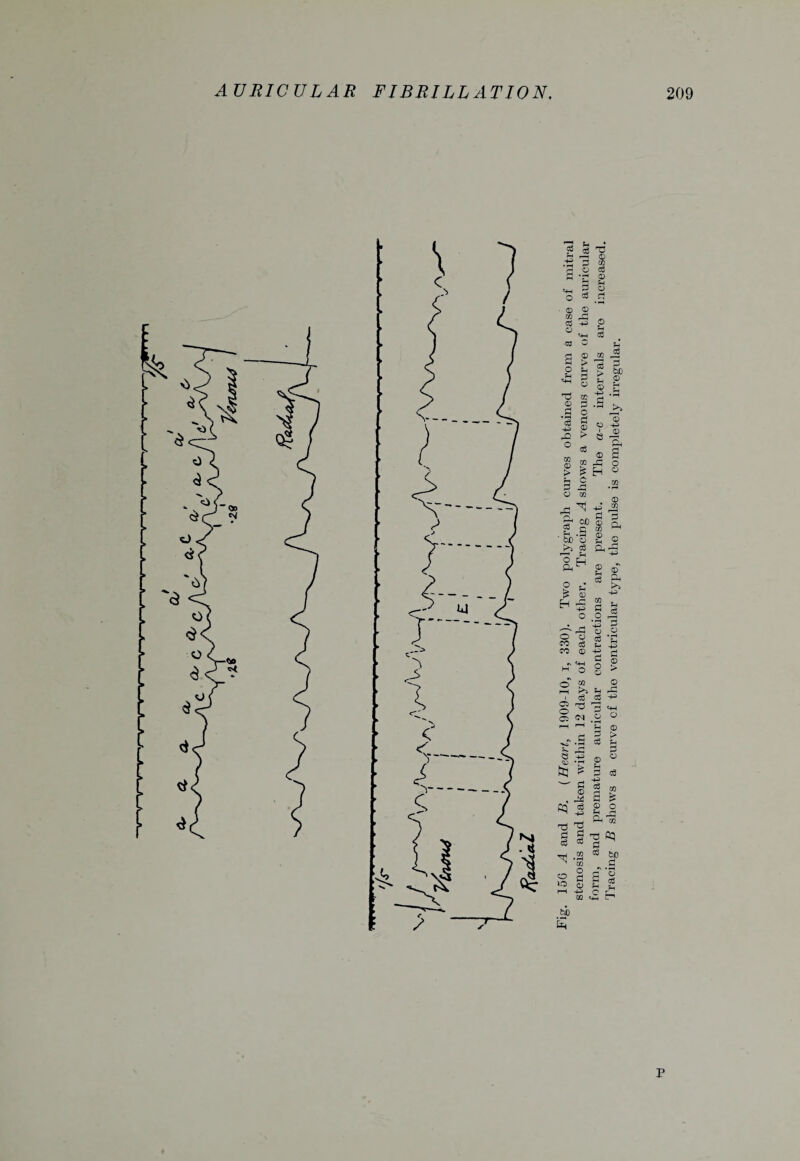 5s cfl T3 J3 ■-< © S3® <-* o CO £ •£ 0 ^ J-l O O © ^ qq _q Ctf -+-> o 03 O - «+H T5 0 .3 C3 o •4H C3 0 05 g 1 ° © 3.1 O e I si r-i O f3 £} O co d ^ ■+= C3 cd oo © ,h.9 be o c8 %4 0 05 3 O r-*H O o o g CO 0 -M •» 'W 0 m /-» y S-J rS 3 0 ^.3 3 § -13 £ £5 * § ~ g ■§ © ^ • -* s cq j g T3 T3 £5 5 T) c3 13 d __j 05 ^ ^ 05 ^ O O r;< o s r—I 4-> 05 • S0 5 p Tracing B shows a curve of the ventricular type, the pulse is completely irregular.