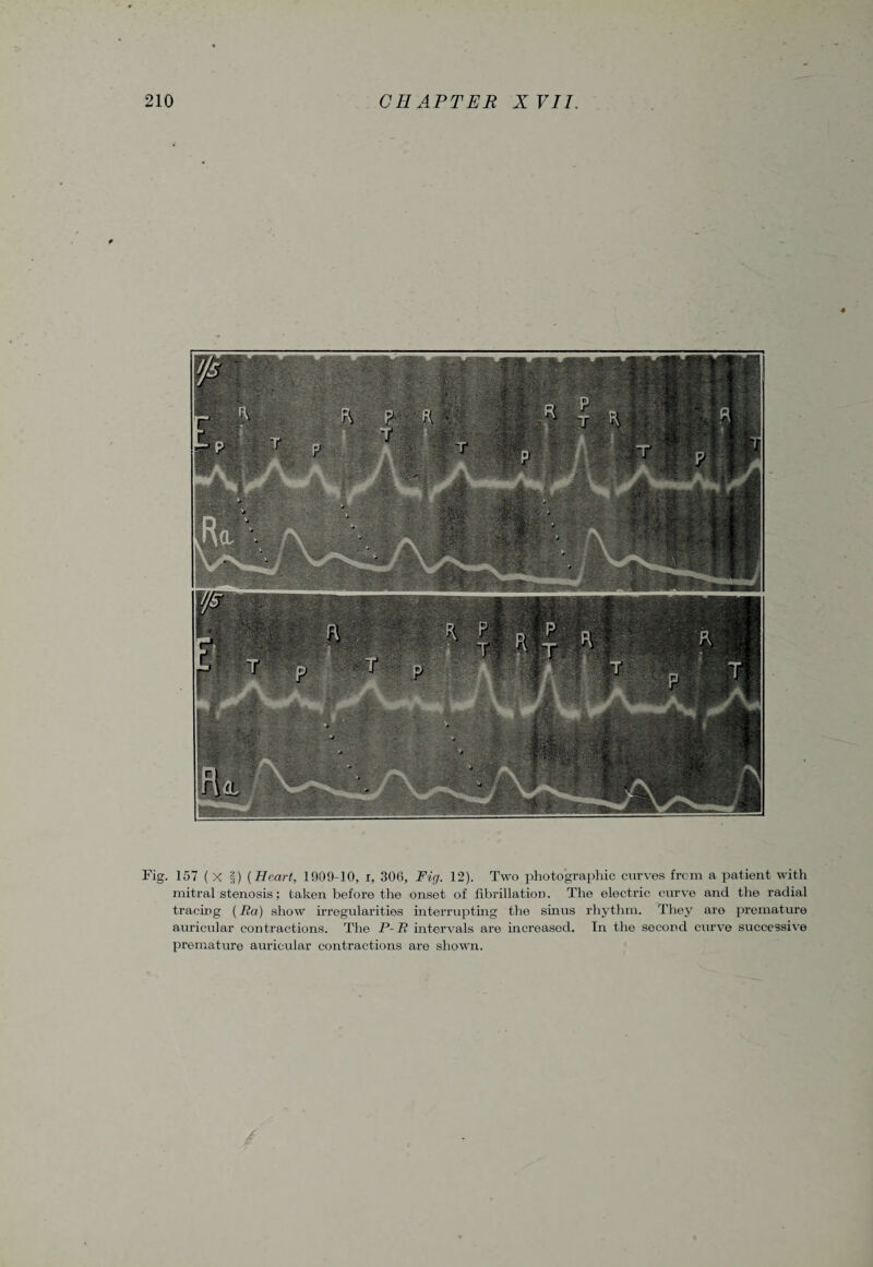 Fig. 157 ( X §) {Heart, 1909-10, r, 306, Fig. 12). Two photographic curves from a patient with mitral stenosis; taken before the onset of fibrillation. The electric curve and the radial tracing (Ila) show irregularities interrupting the sinus rhythm. They are premature auricular contractions. The P-R intervals are increased. In the second curve successive premature auricular contractions are shown.