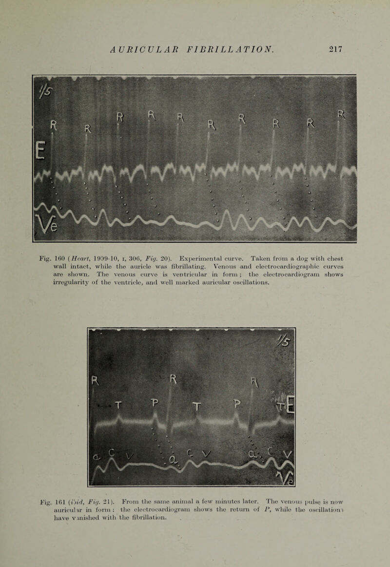 Fig. 160 {Heart, 1909-10, i, 306, Fig. 20). Experimental curve. Taken from a dog with chest wall intact, while the auricle was fibrillating. Venous and electrocardiographic curves are shown. The venous curve is ventricular in form; the electrocardiogram shows irregularity of the ventricle, and well marked auricular oscillations. Fig. 161 (ibid, Fig. 21). From the same animal a few minutes later. The venous pulse is now auricular in form : the electrocardiogram shows the return of P, while the oscillations have vanished with the fibrillation.