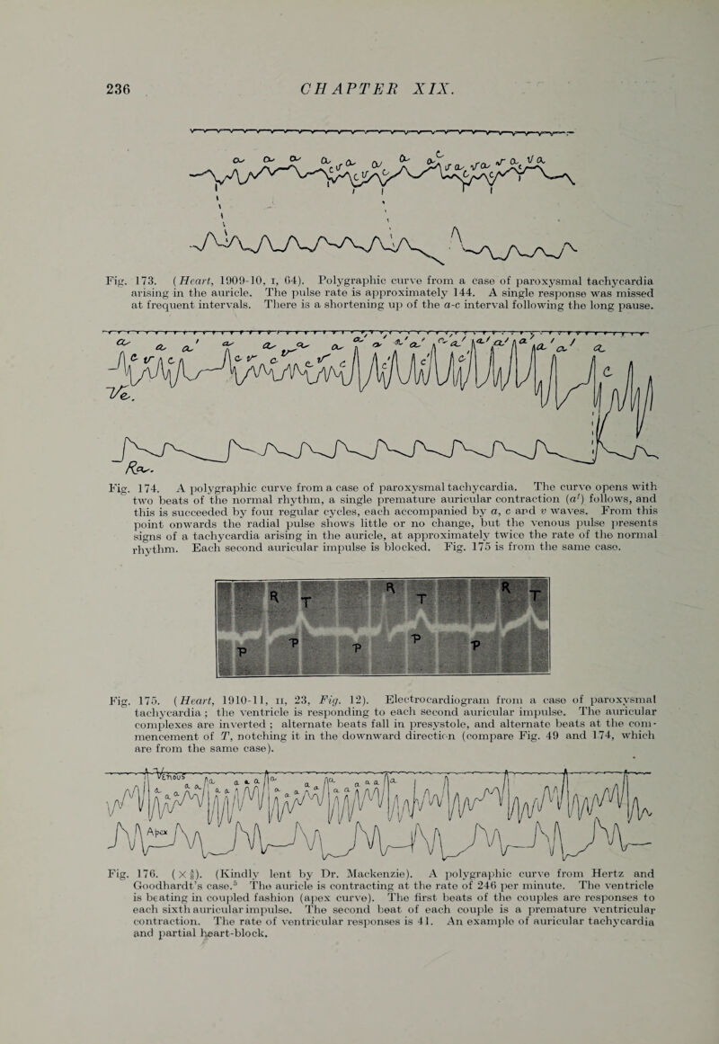 Fig. 173. {Heart, 1009-10. i, 64). Polygraphic curve from a case of paroxysmal tachycardia arising in the auricle. The pulse rate is approximately 144. A single response was missed at frequent intervals. There is a shortening up of the a-c interval following the long pause. Fig. 1 74. A polygraphic curve from a case of paroxysmal tachycardia. The curve opens with two beats of the normal rhythm, a single premature auricular contraction (al) follows, and this is succeeded by four regular cycles, each accompanied by a, c and v waves. From this point onwards the radial pulse shows little or no change, but the venous pulse presents signs of a tachycardia arising in the auricle, at approximately twice the rate of the normal rhythm. Each second auricular impulse is blocked. Fig. 175 is from the same case. Fig. 175. {Heart, 1910-11, ii, 23, Fig. 12). Electrocardiogram from a case of paroxysmal tachycardia; the ventricle is responding to each second auricular impulse. The auricular complexes are inverted ; alternate beats fall in presystole, and alternate beats at the com¬ mencement of T, notching it in the downward direction (compare Fig. 49 and 174, which are from the same case). Fig. 176. (Xf). (Kindly lent by Dr. Mackenzie). A polygraphic curve from Hertz and Goodhardt’s case.5 The auricle is contracting at the rate of 246 per minute. The ventricle is beating in coupled fashion (apex curve). The first beats of the couples are responses to each sixth auricular impulse. The second beat of each couple is a premature ventricular contraction. The rate of ventricular responses is 41. An example of auricular tachycardia and partial heart-block.