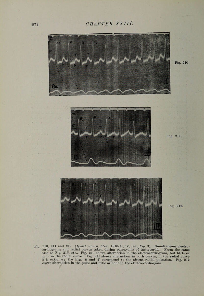 Fig. £10 Fig. 211. Fig. 212. Fig. 210, 211 and 212 {Quart. Journ. Med., 1910-11, iv, 141, Fig. 3). Simultaneous electro¬ cardiograms and radial curves taken during paroxysms of tachycardia. From the same case as Fig. 215, etc.. Fig. 210 shows alternation in the electrocardiogram, but little or none in the radial curve. Fig. 211 shows alternation in both curves, in the radial curve it is extreme; the large B and T correspond to the absent radial pulsation. Fig. 212 shows alternation in the pulse and little or none in the electro-cardiogram.