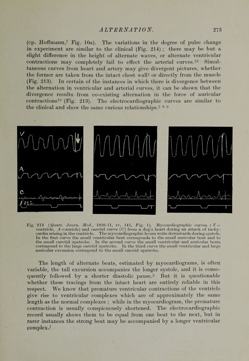 (cp. Hoffmann/ Fig. 10a). The variations in the degree of pulse change in experiment are similar to the clinical (Fig. 214) ; there may be but a slight difference in the height of alternate waves, or alternate ventricular contractions may completely fail to effect the arterial curves.16 Simul¬ taneous curves from heart and artery may give divergent pictures, whether the former are taken from the intact chest wall4 or directly from the muscle (Fig. 213). In certain of the instances in which there is divergence between the alternation in ventricular and arterial curves, it can be shown that the divergence results from co-existing alternation in the force of auricular contractions10 (Fig. 213). The electrocardiographic curves are similar to the clinical and show the same curious relationships.5 & 9 Fig. 213 (Quart. Journ. Med., 1910-11, iv, 141, Fig. 1). Myocardiograpliic curves ( V = ventricle, A = auricle) and carotid curve (C) from a dog’s heart during an attack of tachy¬ cardia arising in the ventricle. The myocardiographic levers write downwards during systole. In the first curve the small ventricular beat corresponds to the small auricular beat and to the small carotid upstroke. In the second curve the small ventricular and auricular beats correspond to the large carotid upstroke. In the third curve the small ventricular and large auricular excursion correspond to the small carotid upstroke. The length of alternate beats, estimated by myocardiograms, is often variable, the tall excursion accompanies the longer systole, and it is conse¬ quently followed by a shorter diastolic pause.2 But it is questionable whether these tracings from the intact heart are entirely reliable in this respect. We know that premature ventricular contractions of the ventricle give rise to ventricular complexes which are of approximately the same length as the normal complexes ; while in the myocardiogram, the premature contraction is usually conspicuously shortened. The electrocardiographic record usually shows them to be equal from one beat to the next, but in rarer instances the strong beat may be accompanied by a longer ventricular complex/