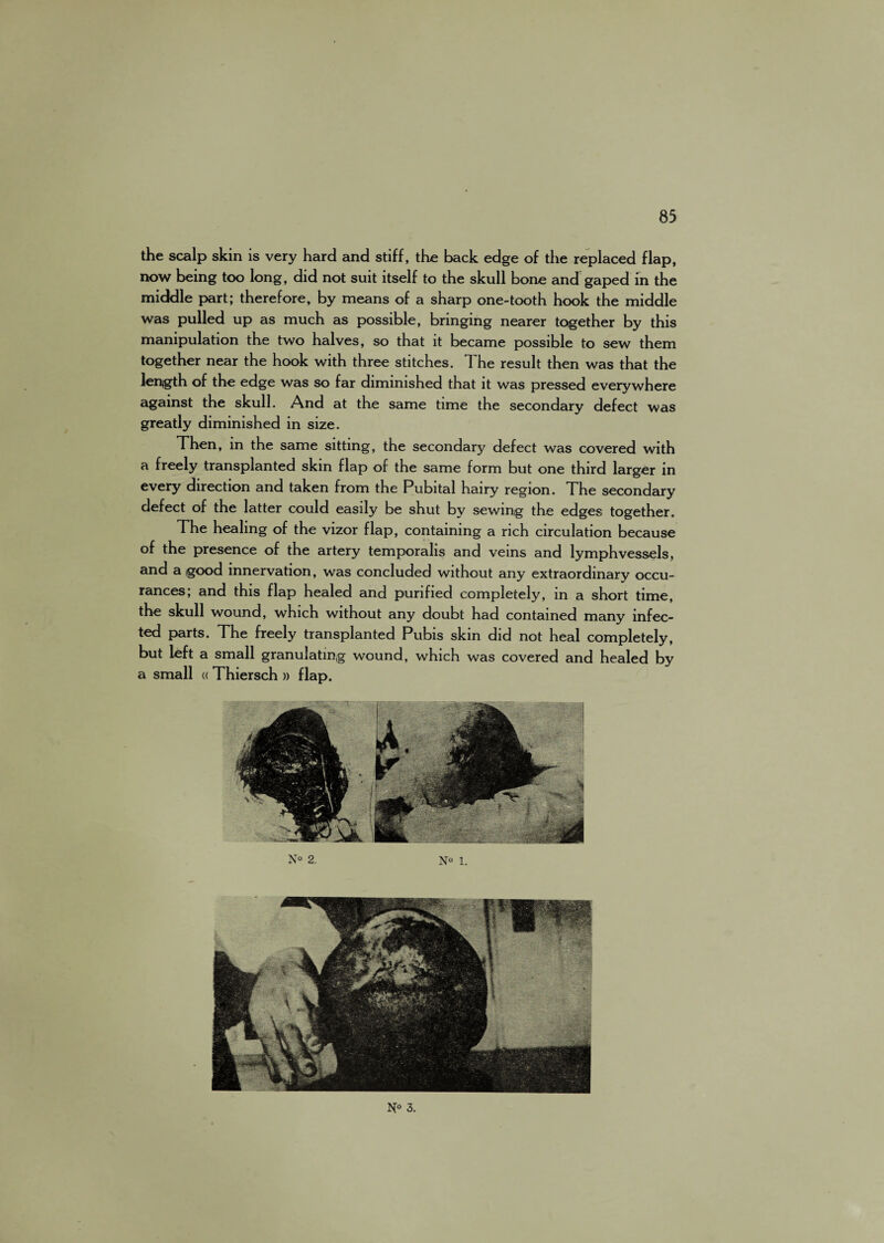 the scalp skin is very hard and stiff, the back edge of the replaced flap, now being too long, did not suit itself to the skull bone and gaped in the middle part; therefore, by means of a sharp one-tooth hook the middle was pulled up as much as possible, bringing nearer together by this manipulation the two halves, so that it became possible to sew them together near the hook with three stitches. The result then was that the lenjgth of the edge was so far diminished that it was pressed everywhere against the skull. And at the same time the secondary defect was greatly diminished in size. Then, in the same sitting, the secondary defect was covered with a freely transplanted skin flap of the same form but one third larger in every direction and taken from the Pubital hairy region. The secondary defect of the latter could easily be shut by sewing the edges together. The healing of the vizor flap, containing a rich circulation because of the presence of the artery temporalis and veins and lymphvessels, and a good innervation, was concluded without any extraordinary occu- rances; and this flap healed and purified completely, in a short time, the skull wound, which without any doubt had contained many infec¬ ted parts. The freely transplanted Pubis skin did not heal completely, but left a small granulating wound, which was covered and healed by a small « Thiersch » flap. 2. N° 1. N° 3.