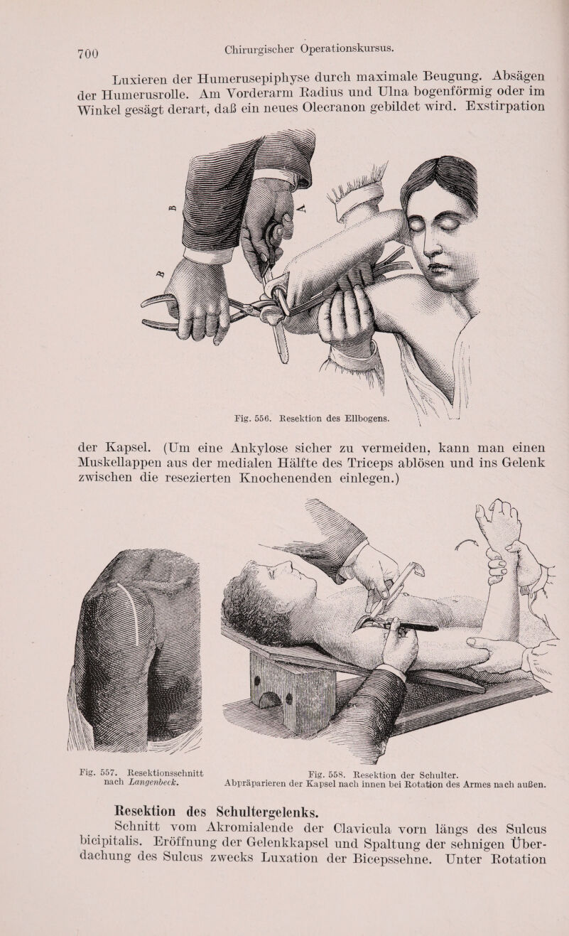 Luxieren der Humerusepiphyse durch maximale Beugung. Absagen der Humerusrolle. Am Vorderarm Radius und Ulna bogenförmig oder im Winkel gesägt derart, daß ein neues Olecranon gebildet wird. Exstirpation der Kapsel. (Um eine Ankylose sicher zu vermeiden, kann man einen Muskellappen aus der medialen Hälfte des Triceps ablösen und ins Gelenk zwischen die resezierten Knochenenden einlegen.) Fig. 557. Resektionsschnitt Fig. 558. Resektion der Schulter. nach Langenbeck. Abpräparieren der Kapsel nach innen bei Rotation des Armes nach außen. Resektion des Schultergelenks. Schnitt vom Akromialende der Clavieula vorn längs des Sulcus bicipitahs. Eröffnung der Gelenkkapsel und Spaltung der sehnigen Über¬ dachung des Sulcus zwecks Luxation der Bicepssehne. Unter Rotation