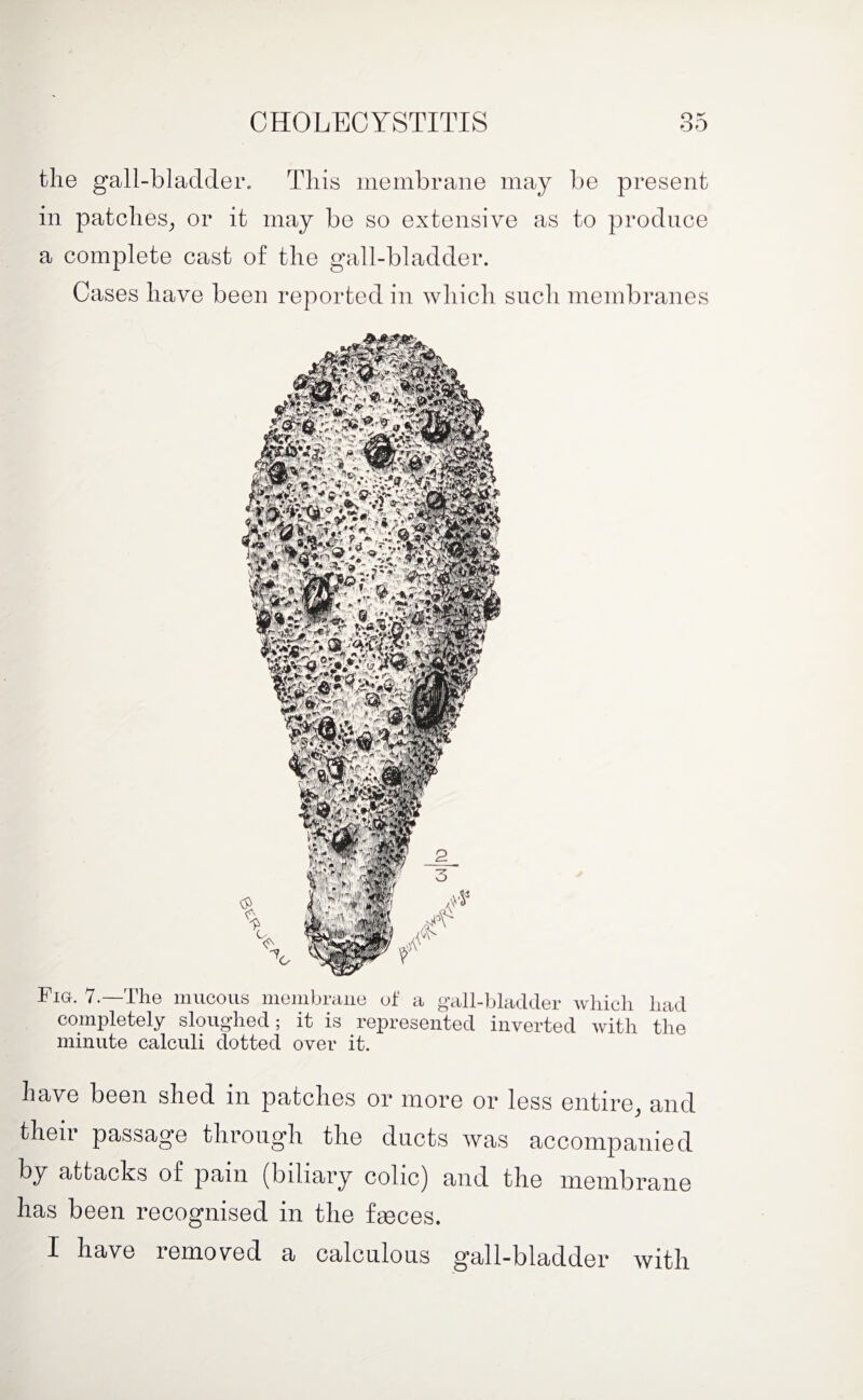 the gall-bladder. This membrane may be present in patches, or it may be so extensive as to produce a complete cast of the gall-bladder. Cases have been reported in which such membranes Fia. 7.—The mucous membrane of a gall-bladder which had completely sloughed; it is represented inverted with the minute calculi dotted over it. have been shed in patches or more or less entire, and their passage through the ducts was accompanied by attacks of pain (biliary colic) and the membrane has been recognised in the feces. X have removed a calculous gall-bladder with