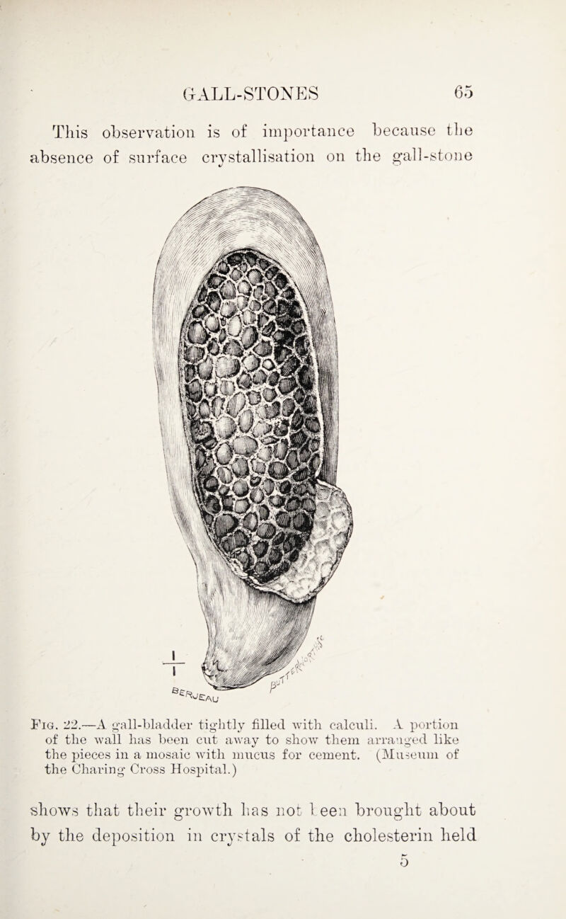 This observation is of importance because the absence of surface crystallisation on the gall-stone Fig. 22.— A gall-bladder tightly filled with calculi. A portion of the wall has been cut away to show them arranged like the pieces in a mosaic with mucus for cement. (Museum of the Charing Cross Hospital.) shows that their growth has not l.een brought about by the deposition in crystals of the cliolesterin held