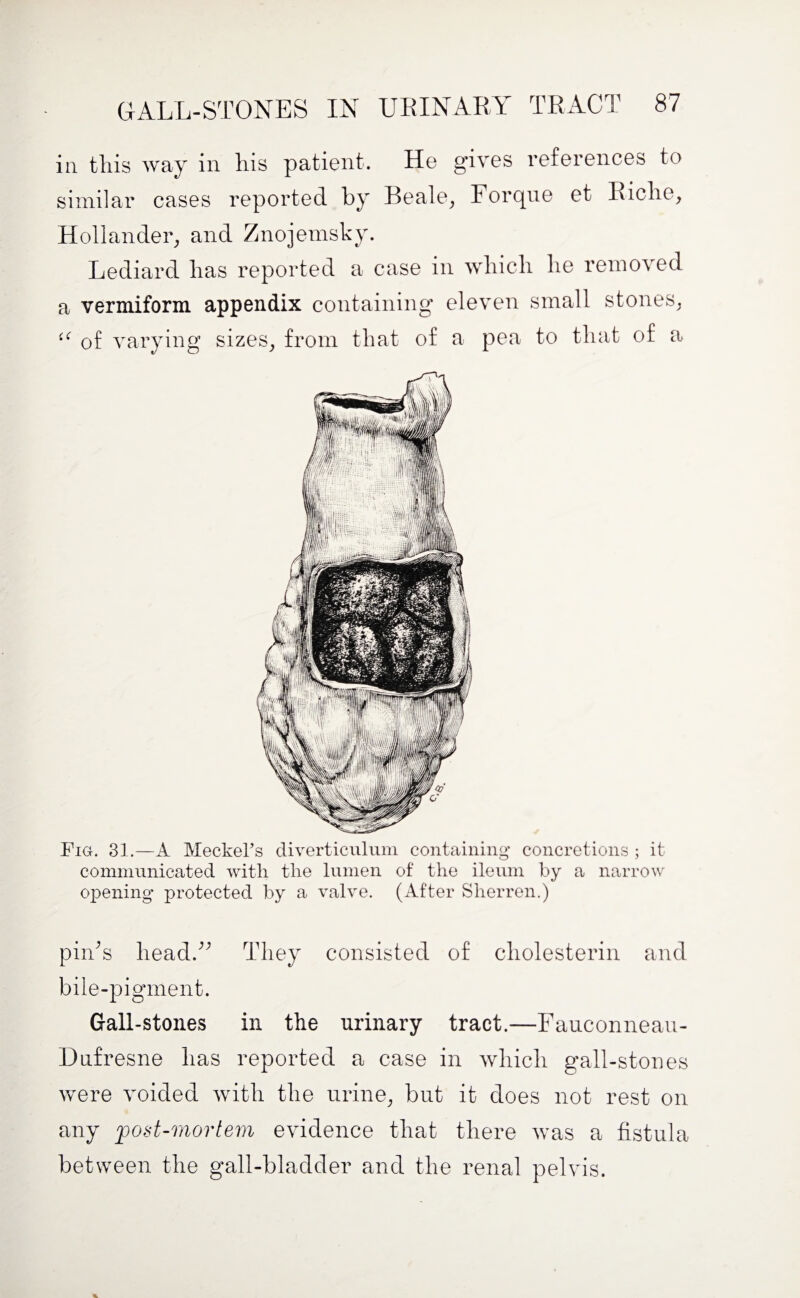 in this way in his patient. He gives references to similar cases reported by Beale, Forqne et Riche, Hollander, and Znojemsky. Lediard has reported a case in which he removed a vermiform appendix containing eleven small stones, (< of varying sizes, from that of a pea to that of a Fig. 31.—A Meckel’s diverticulum containing* concretions ; it communicated with the lumen of the ileum by a narrow opening protected by a valve. (After Sherren.) pin's head. They consisted of cholesterin and bile-pigment. Gall-stones in the urinary tract.—Fauconneau- Dufresne has reported a case in which gall-stones were voided with the urine, but it does not rest on any post-mortem evidence that there was a fistula between the gall-bladder and the renal pelvis.