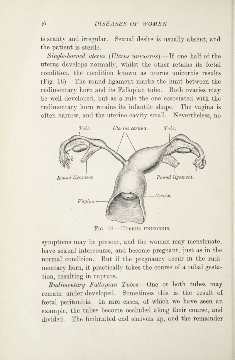 is scanty and irregular. Sexual desire is usually absent, and the patient is sterile. Single-horned uterus (Uterus unicornis).—If one half of the uterus develops normally, whilst the other retains its foetal condition, the condition known as uterus unicornis results (Fig. 16). The round ligament marks the limit between the rudimentary horn and its Fallopian tube. Both ovaries may be well developed, but as a rule the one associated with the rudimentary horn retains its infantile shape. The vagina is often narrow, and the uterine cavity small. Nevertheless, no Tube. Uterine cornua. Tube. Fig. 16.—Uterus unicornis. symptoms may be present, and the woman may menstruate, have sexual intercourse, and become pregnant, just as in the normal condition. But if the pregnancy occur in the rudi¬ mentary horn, it practically takes the course of a tubal gesta¬ tion, resulting in rupture. Rudimentary Fallopian Tubes.—One or both tubes may remain under-developed. Sometimes this is the result of foetal peritonitis. In rare cases, of which we have seen an example, the tubes become occluded along their course, and divided. The fimbriated end shrivels up, and the remainder