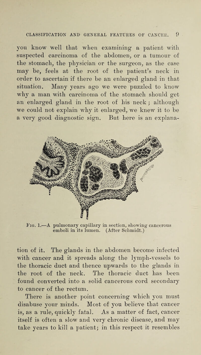 you know well that when examining a patient with suspected carcinoma of the abdomen, or a tumour of the stomach, the physician or the surgeon, as the case may be, feels at the root of the patient’s neck in order to ascertain if there be an enlarged gland in that situation. Many years ago we were puzzled to know why a man with carcinoma of the stomach should get an enlarged gland in the root of his neck ; although we could not explain why it enlarged, we knew it to be a very good diagnostic sign. But here is an explana- Fig. 1.—A pulmonary capillary in section, showing cancerous emboli in its lumen. (After Schmidt.) tion of it. The glands in the abdomen become infected with cancer and it spreads along the lymph-vessels to the thoracic duct and thence upwards to the glands in the root of the neck. The thoracic duct lias been found converted into a solid cancerous cord secondary to cancer of the rectum. There is another point concerning which you must disabuse your minds. Most of you believe that cancer is, as a rule, quickly fatal. As a matter of fact, cancer itself is often a slow and very chronic disease, and may take years to kill a patient; in this respect it resembles