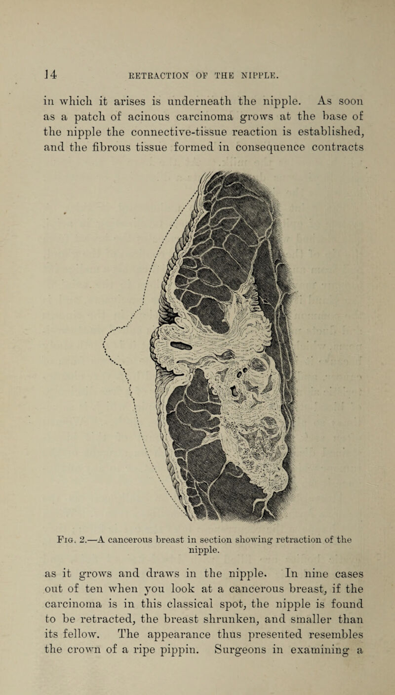 Fig. 2.—A cancerous breast in section showing retraction of the nipple. as it grows and draws in the nipple. In nine cases out of ten when you look at a cancerous breast, if the carcinoma is in this classical spot, the nipple is found to be retracted, the breast shrunken, and smaller than its fellow. The appearance thus presented resembles the crown of a ripe pippin. Surgeons in examining a in which it arises is underneath the nipple. As soon as a patch of acinous carcinoma grows at the base of the nipple the connective-tissue reaction is established, and the fibrous tissue formed in consequence contracts