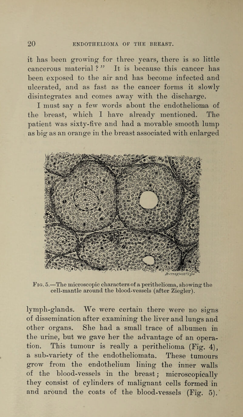 it has been growing for three years, there is so little cancerous material ? ” It is because this cancer has been exposed to the air and lias become infected and ulcerated, and as fast as the cancer forms it slowly disintegrates and comes away with the discharge. I must say a few words about the endothelioma of the breast, which I have already mentioned. The patient was sixty-five and had a movable smooth lump as big as an orange in the breast associated with enlarged Fig. 5.—The microscopic characters of a perithelioma, showing- the cell-mantle around the blood-vessels (after Ziegler). lympli-glands. We were certain there were no signs of dissemination after examining the liver and lungs and other organs. She had a small trace of albumen in the urine, but we gave her the advantage of an opera¬ tion. This tumour is really a perithelioma (Fig. 4), a sub-variety of the endotheliomata. These tumours grow from the endothelium lining the inner walls of the blood-vessels in the breast; microscopically they consist of cylinders of malignant cells formed in and around the coats of the blood-vessels (Fig. 5).'