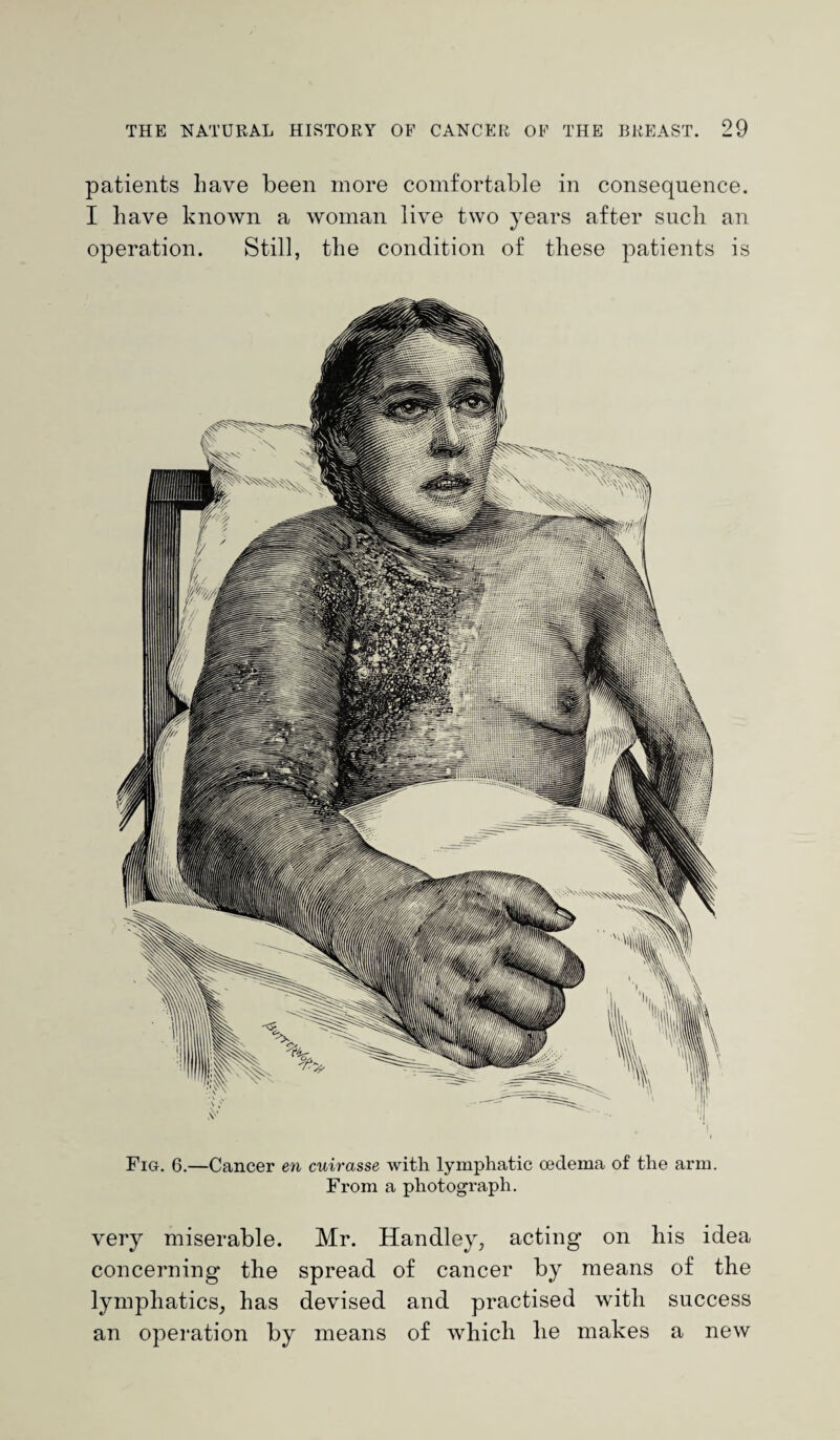patients have been more comfortable in consequence. I have known a woman live two years after such an operation. Still, the condition of these patients is Fig. 6.—Cancer en cuirasse with lymphatic oedema of the arm. From a photograph. very miserable. Mr. Handley, acting on his idea concerning the spread of cancer by means of the lymphatics, has devised and practised with success an operation by means of which he makes a new