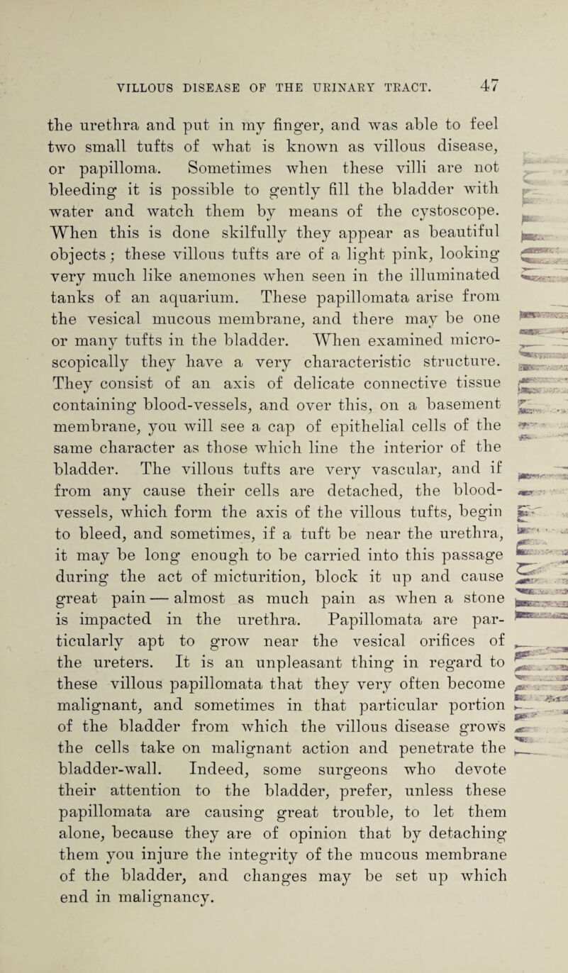 the urethra and put in my finger, and was able to feel two small tufts of what is known as villous disease, or papilloma. Sometimes when these villi are not bleeding it is possible to gently fill the bladder with water and watch them by means of the cystoscope. When this is done skilfully they appear as beautiful objects; these villous tufts are of a light pink, looking very much like anemones when seen in the illuminated tanks of an aquarium. These papillomata arise from the vesical mucous membrane, and there may be one or many tufts in the bladder. When examined micro¬ scopically they have a very characteristic structure. They consist of an axis of delicate connective tissue containing blood-vessels, and over this, on a basement membrane, you will see a cap of epithelial cells of the same character as those which line the interior of the bladder. The villous tufts are very vascular, and if from any cause their cells are detached, the blood¬ vessels, which form the axis of the villous tufts, begin to bleed, and sometimes, if a tuft be near the urethra, it may be long enough to be carried into this passage during the act of micturition, block it up and cause great pain—almost as much pain as when a stone is impacted in the urethra. Papillomata are par¬ ticularly apt to grow near the vesical orifices of the ureters. It is an unpleasant thing in regard to these villous papillomata that they very often become malignant, and sometimes in that particular portion of the bladder from which the villous disease grows the cells take on malignant action and penetrate the bladder-wall. Indeed, some surgeons who devote their attention to the bladder, prefer, unless these papillomata are causing great trouble, to let them alone, because they are of opinion that by detaching them you injure the integrity of the mucous membrane of the bladder, and changes may be set up which end in malignancy. fw. p* N* •• t; ' » SBBtfc r- • v>: I■BSST'.r '-JSt ,*■■11 HU. ^ssai - . 5® ftr vr- :..jb